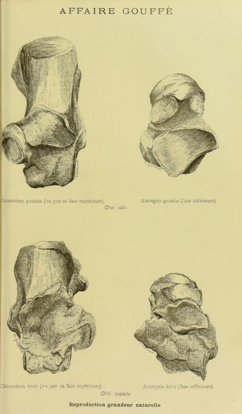 Jaleanoum gauche (vu par sa face supsrieure) C‘te gain Agtragale gauche (face inferieure) !Calcaneum droit (vu par ga face superieure) C6te malade A'jtragale droit (face raferieure) Reproduction grandeur naturelle