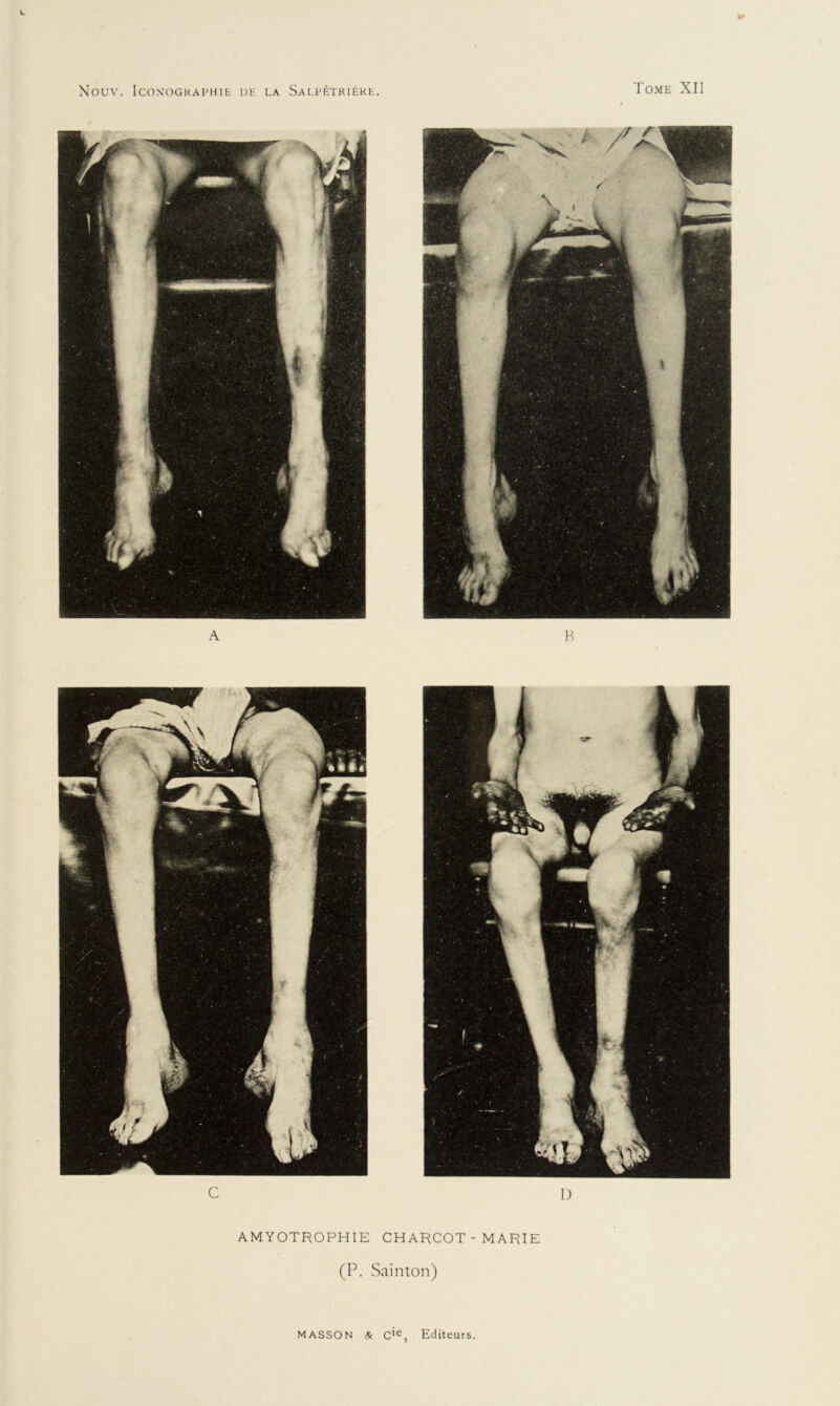 L NOUV. ICONOGRAPHIE UE LA Sal.PÊTRIÈKE. Tome XII A B C I) AMYOTROPHIE CHARCOT - MARIE (P. Sainton)