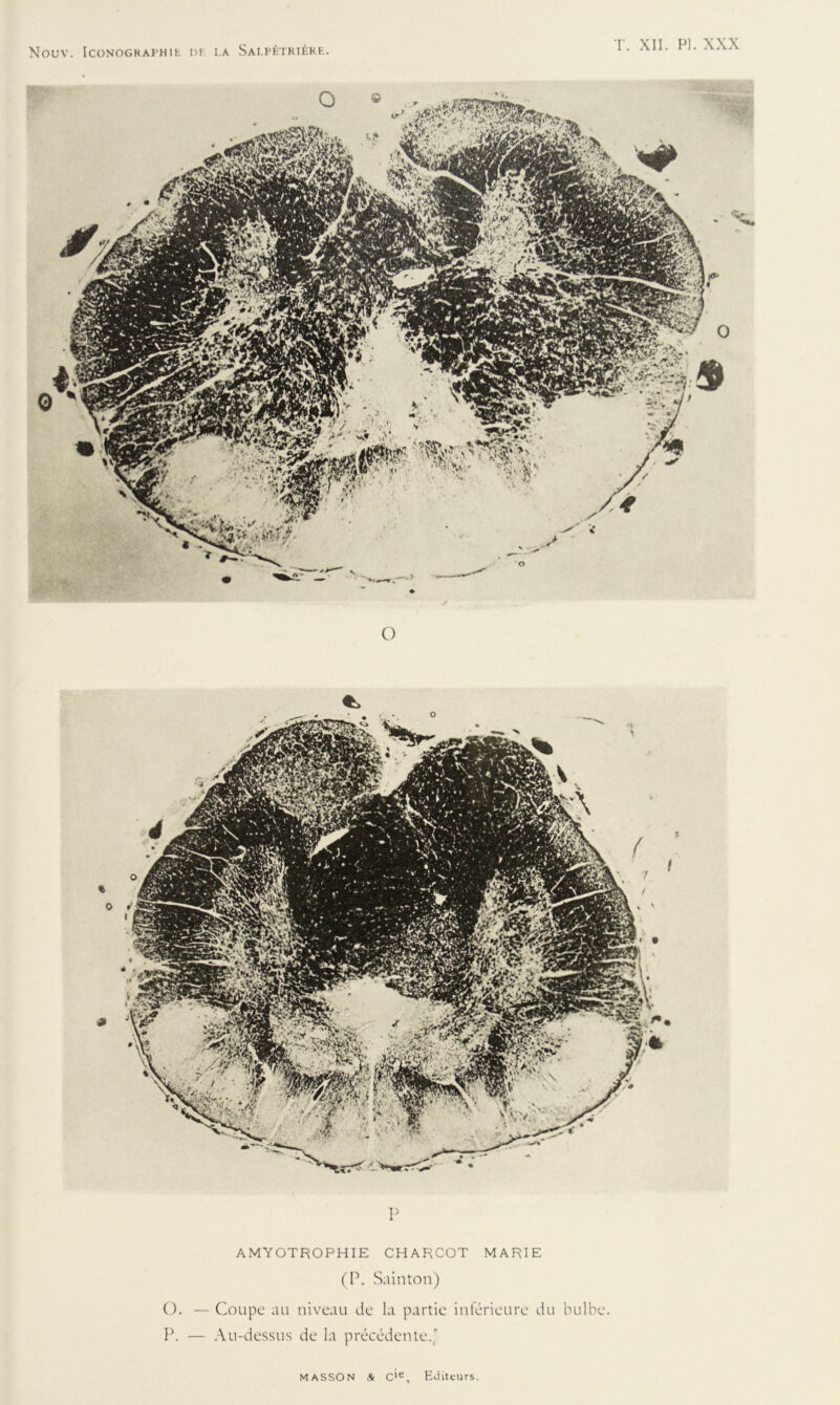 O « O 9 P AMYOTROPHIE CHARCOT MARIE (P. Sainton) O. — Coupe au niveau de la partie inférieure du bulbe. P. — Au-dessus de la précédente..'