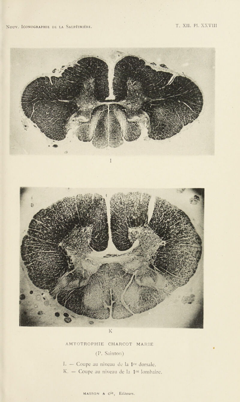 K AMYOTROPHIE CHARCOT MARIE (P. Sain ton) I. — Coupc au niveau de la lre dorsale. K. — Coupe au niveau de la lre lombaire.