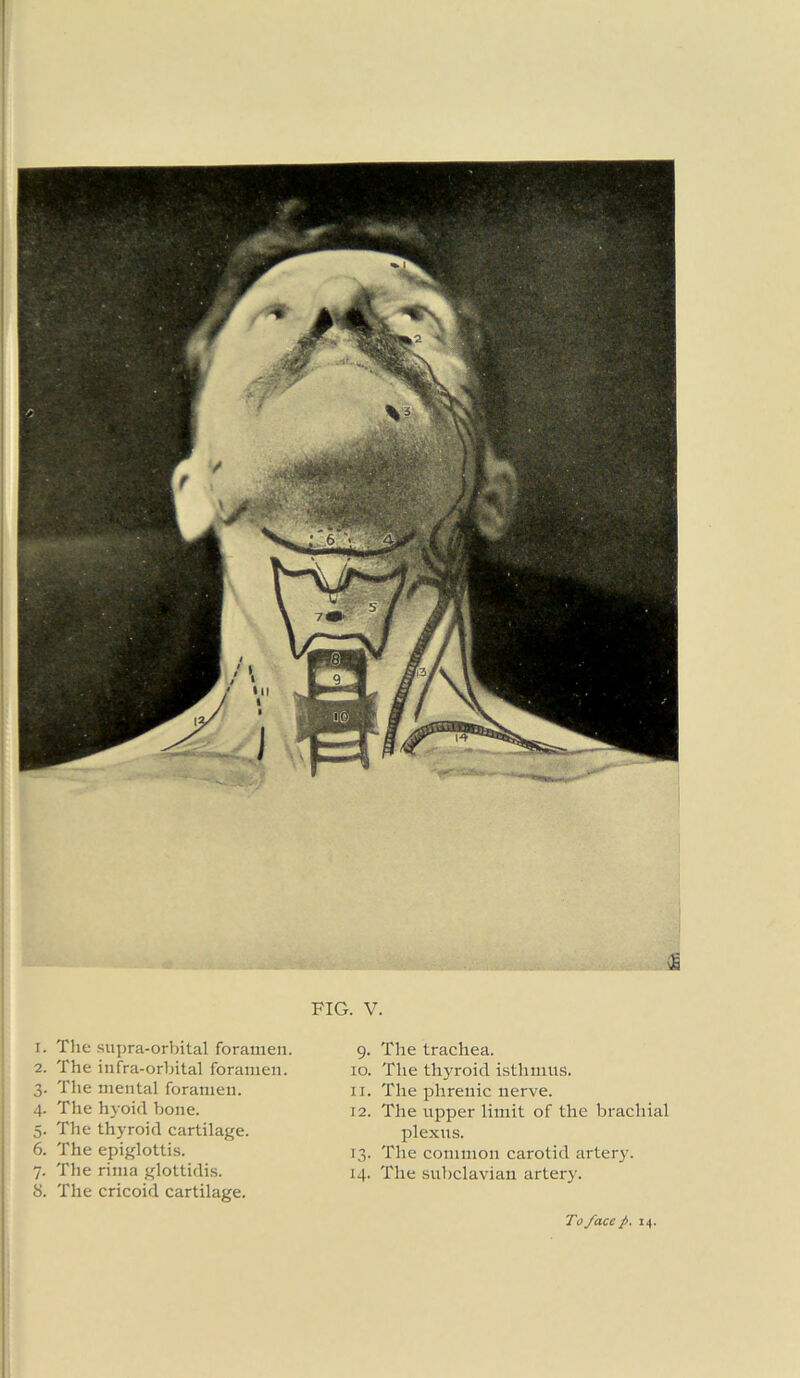 CC FIG. V. 2. The infra-orbital foramen. 3. The mental foramen. 4. The hyoid bone. 5. The thyroid cartilage. 6. The epiglottis. . The rima glottidis. . The cricoid cartilage. 10. The thyroid isthmus. 11. The phrenic nerve. 12. The upper limit of the brachial plexus. 13. The common carotid artery. 14. The subclavian artery.