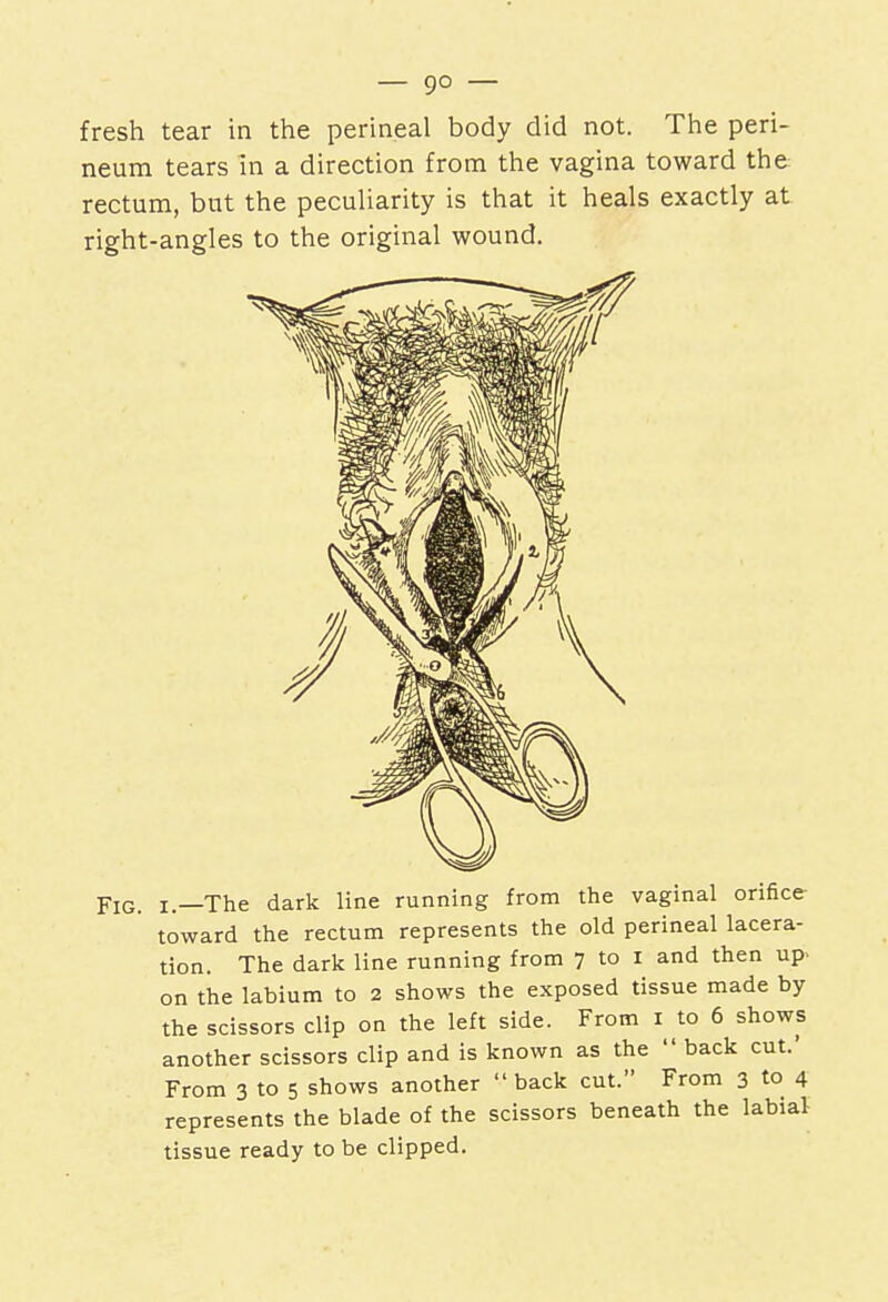 fresh tear in the perineal body did not. The peri- neum tears In a direction from the vagina toward the rectum, but the peculiarity is that it heals exactly at right-angles to the original wound. Fig, l—The dark line running from the vaginal orifice toward the rectum represents the old perineal lacera- tion. The dark line running from 7 to 1 and then up> on the labium to 2 shows the exposed tissue made by the scissors clip on the left side. From 1 to 6 shows another scissors clip and is known as the  back cut.' From 3 to 5 shows another back cut. From 3 to 4 represents the blade of the scissors beneath the labial tissue ready to be clipped.