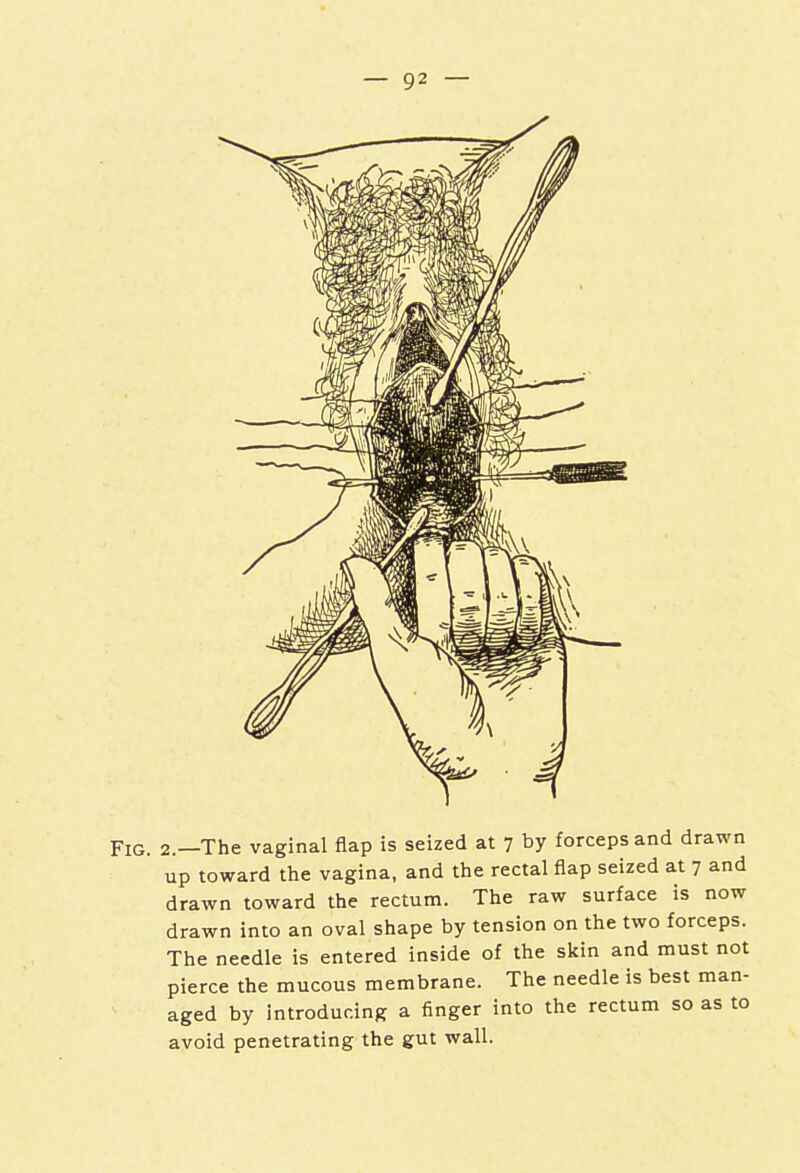 Fig. 2.—The vaginal flap is seized at 7 by forceps and drawn up toward the vagina, and the rectal flap seized at 7 and drawn toward the rectum. The raw surface is now drawn into an oval shape by tension on the two forceps. The needle is entered inside of the skin and must not pierce the mucous membrane. The needle is best man- aged by introducing a finger into the rectum so as to avoid penetrating the gut wall.