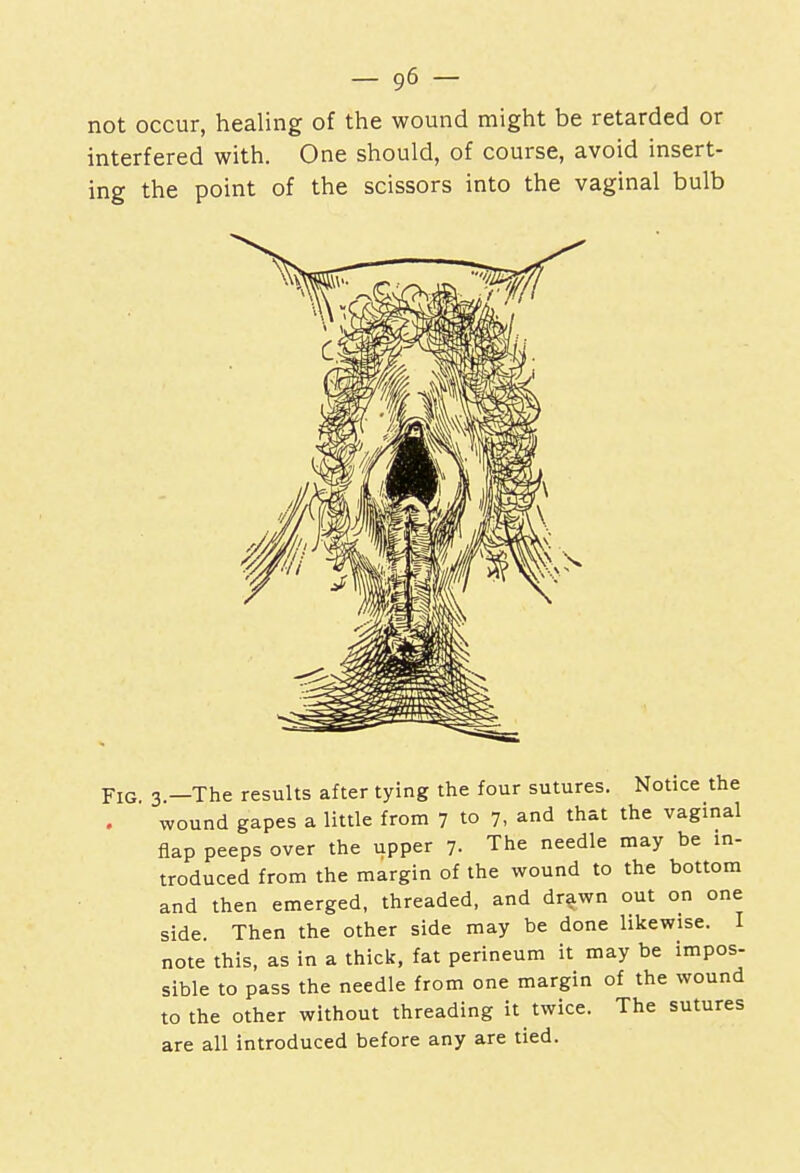 not occur, healing of the wound might be retarded or interfered with. One should, of course, avoid insert- ing the point of the scissors into the vaginal bulb Fig. 3—The results after tying the four sutures. Notice the wound gapes a little from 7 to 7, and that the vaginal flap peeps over the upper 7. The needle may be in- troduced from the margin of the wound to the bottom and then emerged, threaded, and drawn out on one side. Then the other side may be done likewise. I note this, as in a thick, fat perineum it may be impos- sible to pass the needle from one margin of the wound to the other without threading it twice. The sutures are all introduced before any are tied.