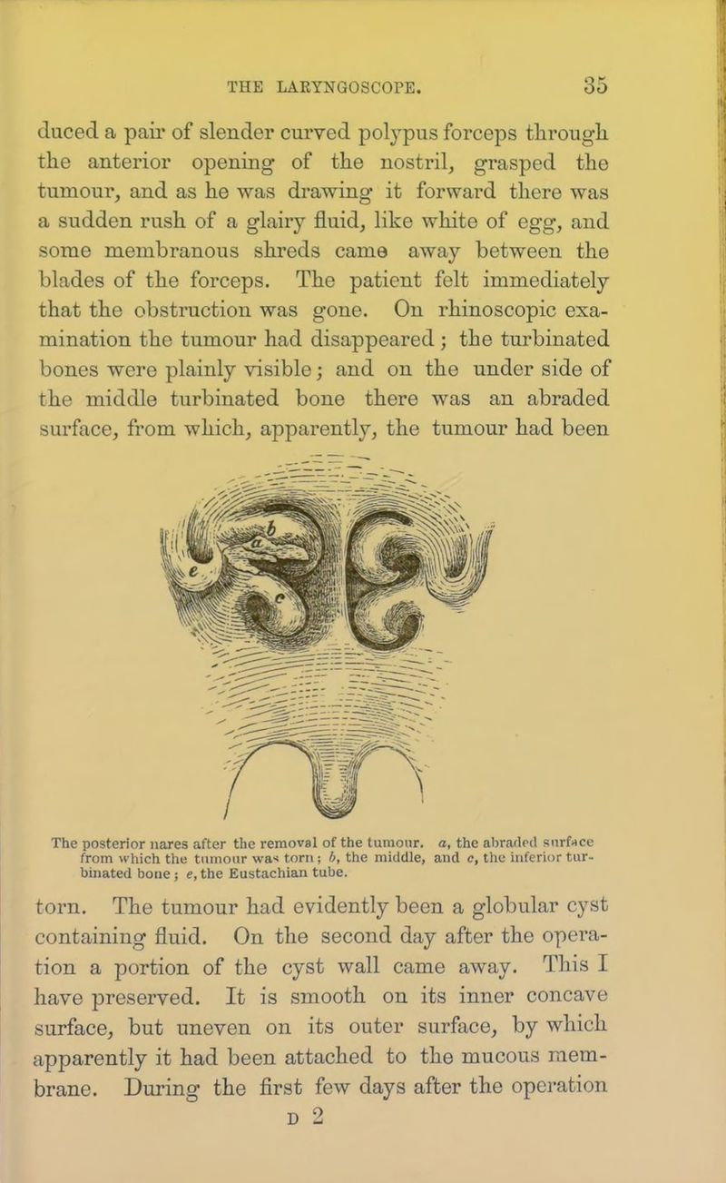 duced a pair of slender curved polypus forceps tlirougli the anterior opening of the nostril, grasped the tumour, and as he was drawing it forward there was a sudden rush of a glairy fluid, like white of egg, and some membranous shreds came away between the blades of the forceps. The patient felt immediately that the obstruction was gone. On rhinoscopic exa- mination the tumour had disappeared ; the turbinated bones were plainly visible; and on the under side of the middle turbinated bone there was an abraded surface, from which, apparently, the tumour had been The posterior iiares after the removal of the tumour, a, the abraded snrf>tce from which the tumour wa< torn; b, the middle, and c, the uiferior tur- binated bone; e,the Eustachian tube. torn. The tumour had evidently been a globular cyst containing fluid. On the second day after the opera- tion a portion of the cyst wall came away. This I have preserved. It is smooth on its inner concave surface, but uneven on its outer surface, by which apparently it had been attached to the mucous mem- brane. During the first few days after the operation D 2