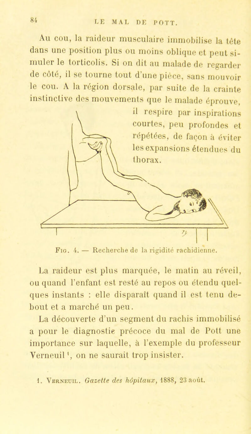 Au cou, la raideur musculaire immobilise la tête dans une position plus ou moins oblique et peut si- muler le torticolis. Si on dit au malade de regarder de côté, il se tourne tout d’une pièce, sans mouvoir le cou. A la région dorsale, par suite de la crainte instinctive des mouvements que le malade éprouve, il respire par inspirations courtes, peu profondes et répétées, de façon à éviter les expansions étendues du thorax. Fig. 4. — Recherche de la rigidité rachidienne. La raideur est plus marquée, le matin au réveil, ou quand l’enfant est resté au repos ou étendu quel- ques instants : elle disparaît quand il est tenu de- bout et a marché un peu. La découverte d’un segment du rachis immobilisé a pour le diagnostie précoce du mal de Pott une importance sur laquelle, à l’exemple du professeur Verneuil on ne saurait trop insister. 1. Verneuil. Gazette des hôpitaux, 1888, 23 août.