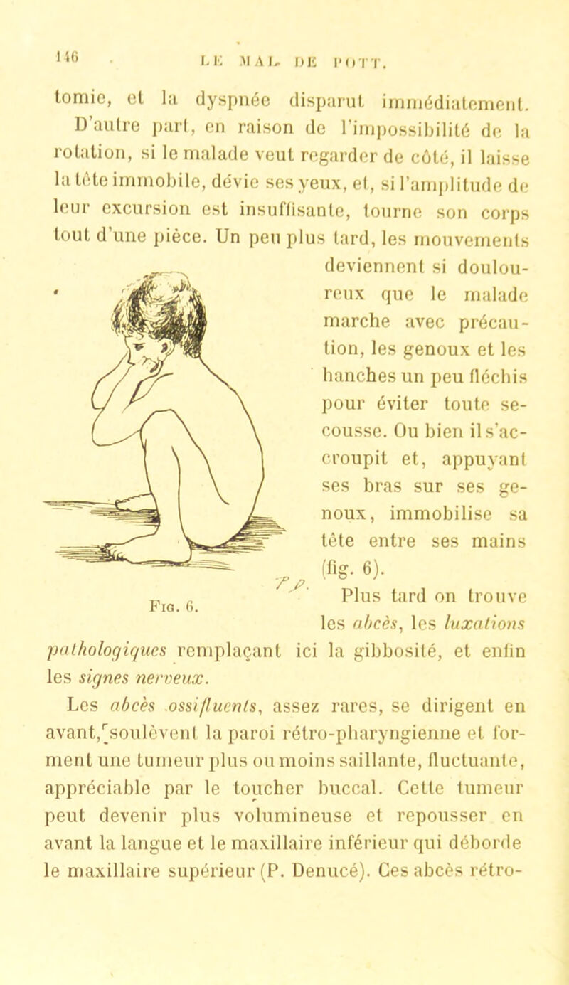 LE MAU DE I* O TT. lomie, et l;i dyspnée disparut immédiatement. D’autre part, en raison de l’impossibilité de la rotation, si le malade veut regarder de côté, il laisse la tète immobile, dévie ses yeux, et, si l’amplitude de leur excursion est insuffisante, tourne son corps tout d’une pièce. Un peu plus lard, les mouvements deviennent si doulou- reux que le malade marche avec précau- tion, les genoux et les hanches un peu fléchis pour éviter toute se- cousse. Ou bien il s’ac- croupit et, appuyant ses bras sur ses ge- noux, immobilise sa tête entre ses mains (%• 6). Plus tard on trouve les abcès, les luxations pathologiques remplaçant ici la gibbosité, et enfin les signes nerveux. Les abcès .ossi/luents, assez rares, se dirigent en avant,^soulèvent la paroi rétro-pharyngienne et for- ment une tumeur plus ou moins saillante, fluctuante, appréciable par le toucher buccal. Cette tumeur peut devenir plus volumineuse et repousser en avant la langue et le maxillaire inférieur qui déborde le maxillaire supérieur (P. Denucé). Ces abcès rétro-