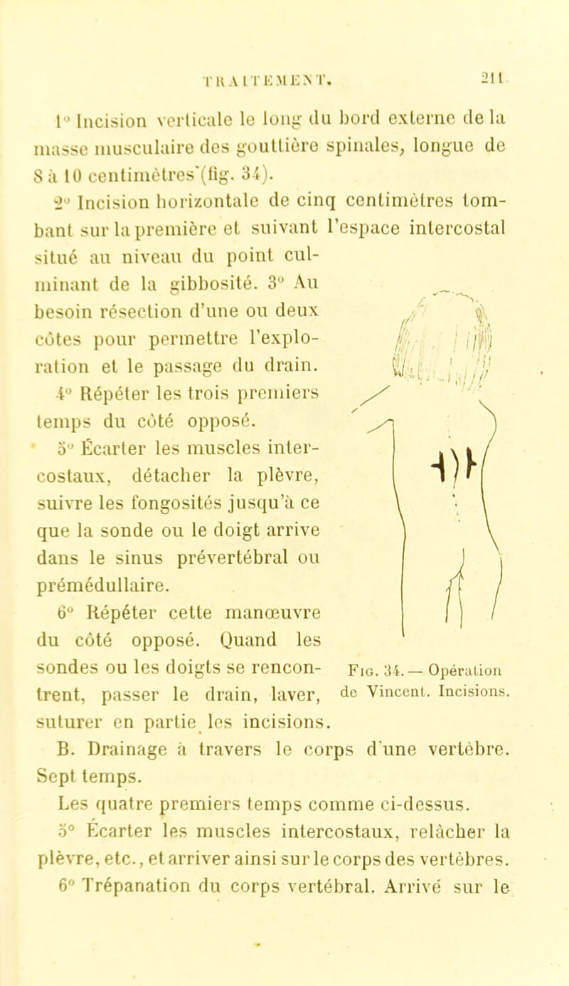1° Incision verticale le long du bord externe delà masse musculaire des gouttière spinales, longue de 8 à 10 centimètres'(fig. 34). w2° Incision horizontale de cinq centimètres tom- bant sur la première et suivant l’espace intercostal situé au niveau du point cul- minant de la gibbosité. 3° Au besoin résection d’une ou deux côtes pour permettre l’explo- ration et le passage du drain. ■t° Répéter les trois premiers temps du côté opposé. 5° Écarter les muscles inter- costaux, détacher la plèvre, suivre les fongosités jusqu’à ce que la sonde ou le doigt arrive dans le sinus prévertébral ou prémédullaire. 6° Répéter cette manœuvre du côté opposé. Quand les sondes ou les doigts se rencon- trent, passer le drain, laver, de Vincent. Incisions, suturer en partie les incisions. B. Drainage à travers le corps d'une vertèbre. Sept temps. Les quatre premiers temps comme ci-dessus. o° Ecarter les muscles intercostaux, relâcher la plèvre, etc., et arriver ainsi sur le corps des vertèbres. 6° Trépanation du corps vertébral. Arrivé sur le