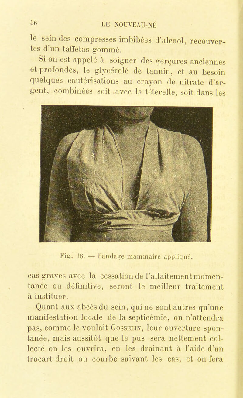 le sein des compresses imbibées d'alcool, recouver- tes d'un taffetas gommé. Si on est appelé cà soigner des gerçures anciennes et profondes, le glycérolé de tannin, et au besoin quelques cautérisations au crayon de nitrate d'ar- gent, combinées soit .avec la téterelle, soit dans les Fig. 16, — Uanclaf,'e mammaire appliqué. cas graves avec la cessation de l'allaitement momen- tanée ou définitive, seront le meilleur traitement à instituer. Quant aux abcès du sein, qui ne sont autres qu'une manifestation locale de la septicémie, on n'attendra pas, comme le voulait Gosselin, leur ouverture spon- tanée, mais aussitôt que le pus sera nettement col- lecté on les ouvrira, en les drainant à l'aide d'un trocart droit ou courbe suivant les cas, et on fera