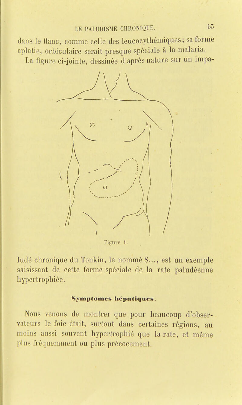 55 dans le flanc, comme celle des leucocylhémiques; sa forme aplatie, orbiculaire serait presque spéciale à la malaria. La figure ci-jointe, dessinée d'après nature sur un impa- Fitmre 1. ludé chronique du Tonkin, le nommé S..., est un exemple saisissant de cette forme spéciale de la rate paludéenne hypertrophiée. Symptômes hépatiques. Nous venons de montrer que pour beaucoup d'obser- vateurs le foie était, surtout dans certaines régions, au moins aussi souvent hypertrophié que la rate, et même plus fréquemment ou plus précocement.
