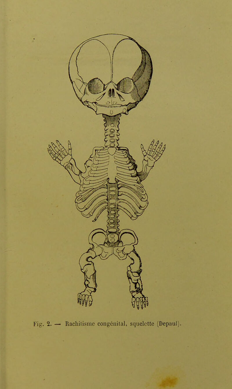 Rachilisme congénital, squelette (Depaul).