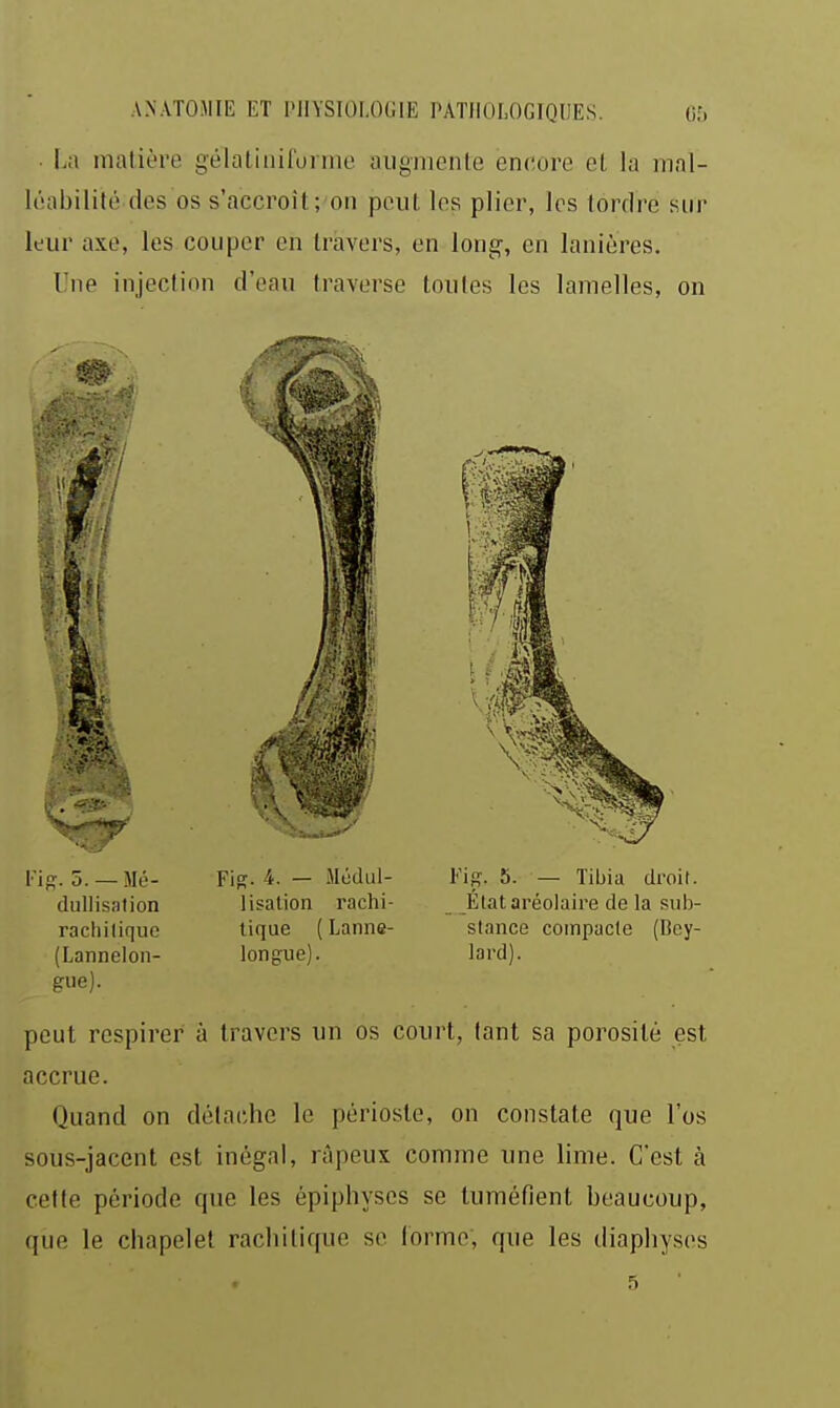 La matière gélatiniforme augmente encore et la mal- léabilité des os s'accroît; on peut les plier, les tordre siii- leur axe, les couper en travers, en long, en lanières. Une injection d'eau traverse toutes les lamelles, on FiR. 5. — Mé- dullisalion rachilique (Lannelon- gue). FiK- 4- — Médul- lisation rachi- lique ( Lanne- longue). Fig. 5. — Tibia droit. Élataréolaire de la siib- slance compacte (Bey- lard). peut respirer à travers un os court, tant sa porosité est accrue. Quand on détache le périoste, on constate que l'os sous-jacent est inégal, râpeux comme une lime. C'est à cette période que les épiphyses se tuméfient beaucoup, que le chapelet rachilique se (orme, que les diaphysos