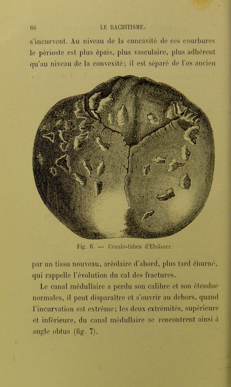 s'incurvent. Au niveau de la concavité de ces courbures le périoste est plus épais, plus vasculaire, plus adhérent qu'au niveau de la convexité; il est séparé de l'os ancien Fig. 6. — Cranio-labcs d'Elsiisscr. par un tissu nouveau, aréolaire d'abord, plus tard éburnc', qui rappelle l'évolution du cal des fractures. Le canal médullaire a perdu son calibre et son étendue normales, il peut disparaître et s'ouvrir au dehors, quand l'incurvation est extrême; les deux extrémités, supérieure et inférieure, du canal médullaire se rencontrent ainsi à angle obtus (fig. 7).