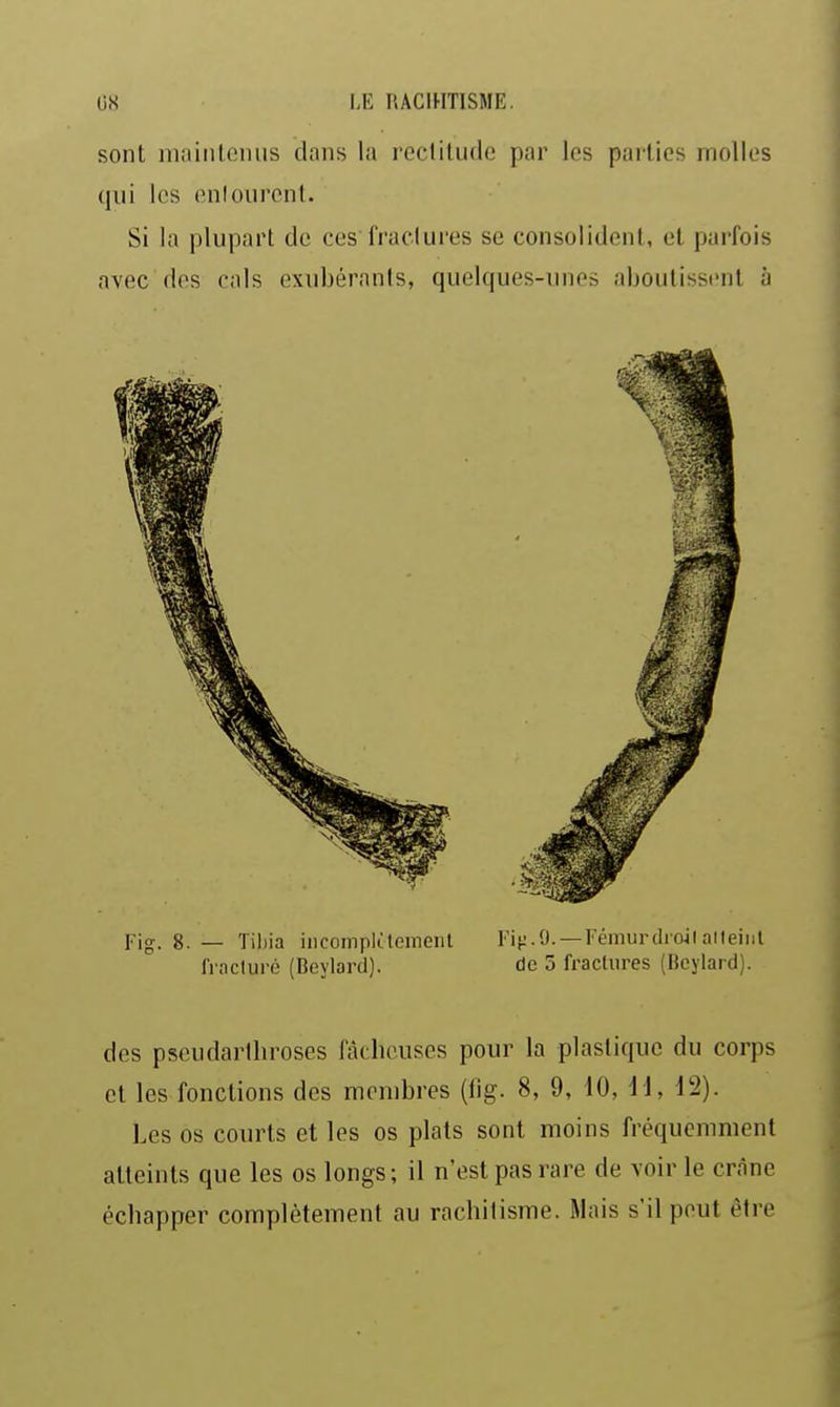 sont maiiitcmis dans la reclilude par les parties molles qui les (înlourcnt. Si la plupart do ces fractures se consolident, et parfois avec dos cals exubérants, quelques-unes aboutissent à Fig. 8. — Tihia iiicomplilement ri^i/J. —Fémurdroilaileint fracluré (Beylard). de 5 fractures (Beylard). des pseudarlhroses fâcheuses pour la plastique du corps et les fonctions des membres (iig. 8, 9, 10, 11, 12). Les os courts et les os plats sont moins fréquemment atteints que les os longs; il n'est pas rare de voir le crâne échapper complètement au rachitisme. Mais s'il peut être