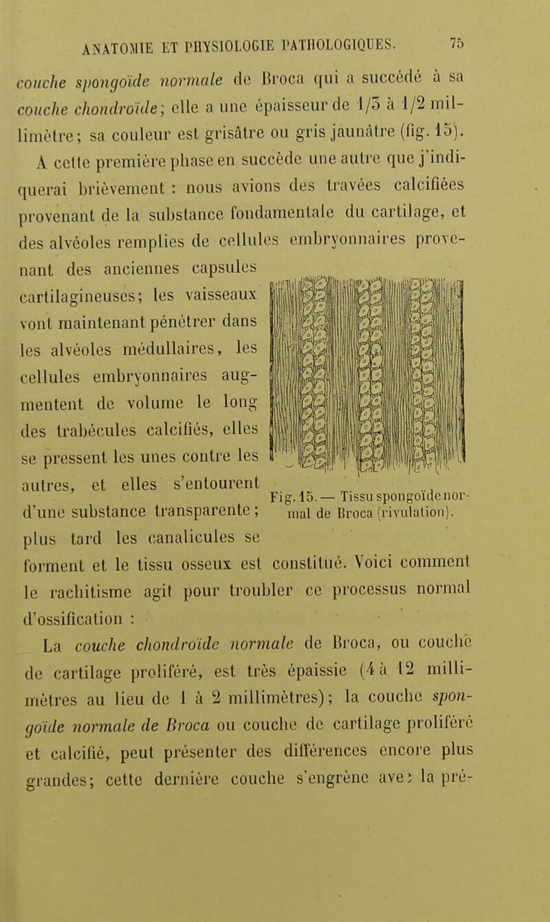 couche spongoïde normale do Broca qui a succédé à sa couche chondroide ; elle a une épaisseur de I/o à 1/2 mil- limètre; sa couleur est grisâtre ou gris jaunâtre (fig. 15). A cette première phase en succède une autre que j'indi- querai brièvement : nous avions des travées calcifiées provenant de la substance fondamentale du cartilage, et des alvéoles remplies de cellules embryonnaires prove- nant des anciennes capsules cartilagineuses; les vaisseaux vont maintenant pénétrer dans les alvéoles médullaires, les cellules embryonnaires aug- mentent de volume le long des trabécules calcifiés, elles se pressent les unes contre les autres, et elles s'entourent d'une substance transparente ; plus tard les canalicules se forment et le tissu osseux est constitué. Voici comment le rachitisme agit pour troubler ce processus normal d'ossification : La couche chondroide normale de Broca, ou couché de cartilage proliféré, est très épaissie (4 à 12 milli- mètres au lieu de 1 à 2 millimètres) ; la couche spon- goïde normale de Broca ou couche de cartilage proliféré et calcifié, peut présenter des différences encore plus grandes; cette dernière couche s'engrène ave; la pré- Fig. 15.— Tissu spongoïdenor- mal de Broca (rivulation).