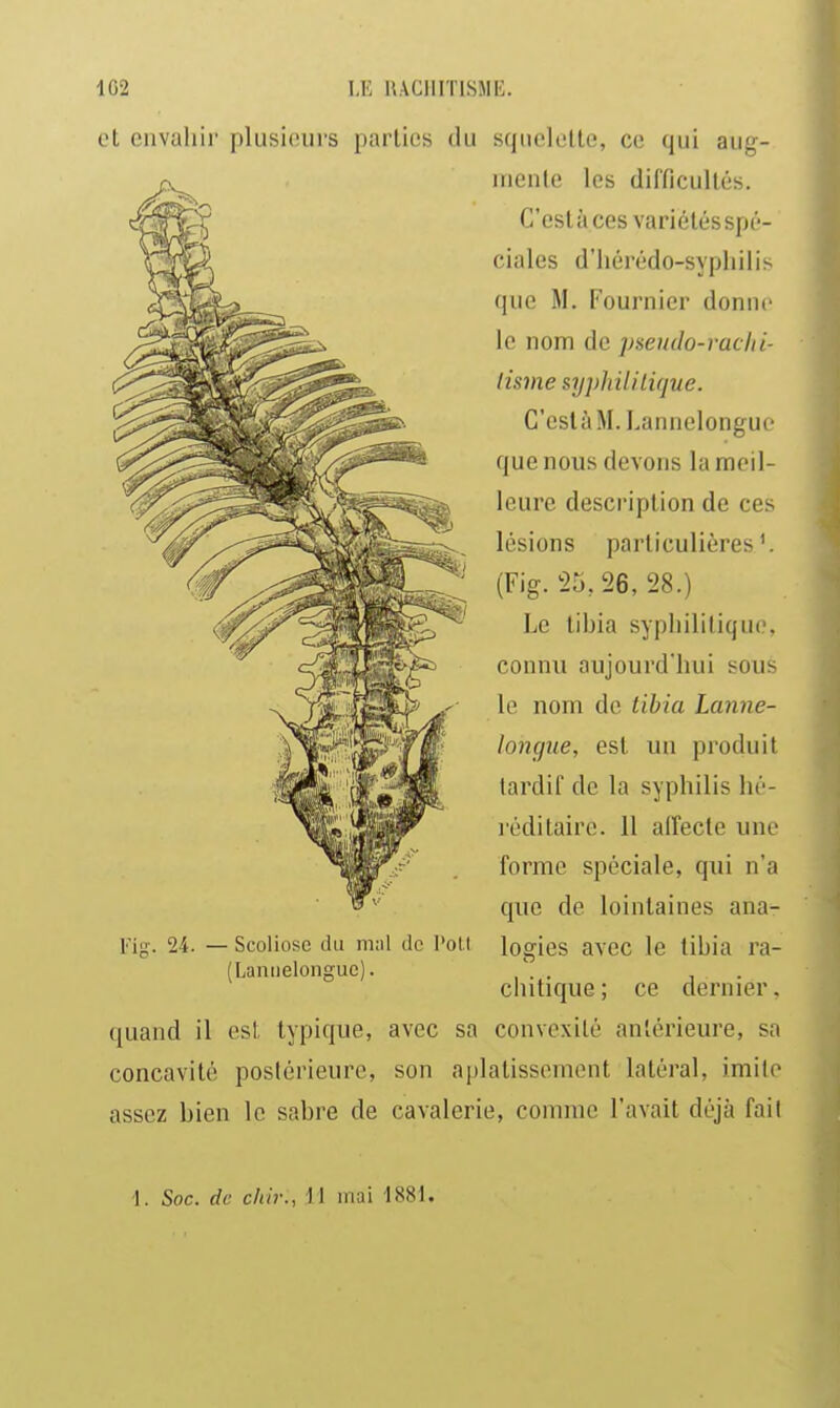 et envahir plusieurs parties du sqiielclle, ce qui aug- irienle les difficultés. C'estàces variétésspé- ciales d'hérédo-syphilis que M. Fournier donne le nom de pseudo-raclii- lisme sypliililùjue. C'eslàM.Lannelonguc que nous devons la meil- leure description de ces lésions particulières'. (Fig. 25,26, 28.) Le tibia syphilitique, connu aujourd'hui sous le nom de tibia Lanne- lonçjue, est un produit tardif de la syphilis hé- léditaire. Il affecte une forme spéciale, qui n'a que de lointaines ana- logies avec le tibia ra- chitique ; ce dernier. quand il est typique, avec sa convexité antérieure, sa concavité postérieure, son aplatissement latéral, imite assez bien le sabre de cavalerie, comme l'avait déjà fait l'iff. 24. - Scoliose du miil de l'oll (Laniielonguc). 1. Soc. de cfiir., fl mai 1881.