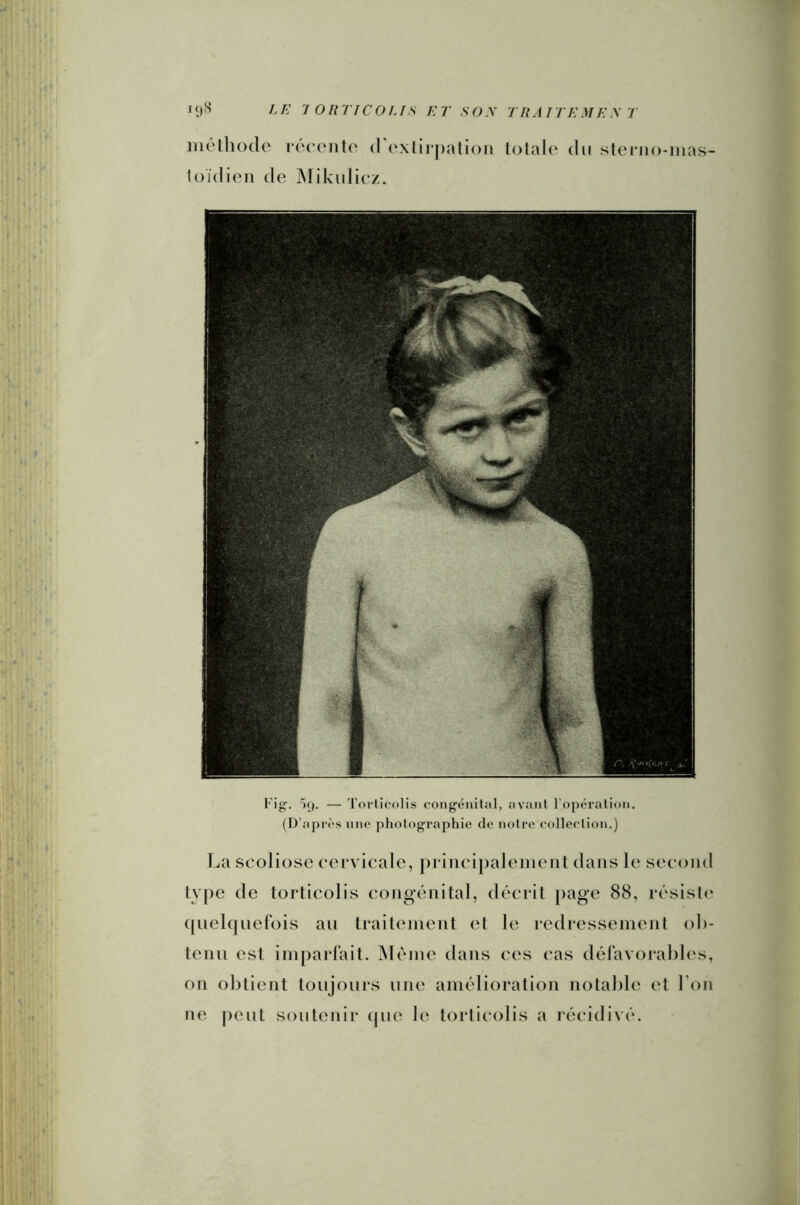 mélliodo réc'onlo (]\‘xlii|)ati()ii lolale du steriio-nias- loïdieii de Mikuliez. Fig. H), — Toi'licolis congénital, avant l’opération. (D’aprcs nnc photographie de notre collection.) La scoliose cervicale, |)riiici|)aleiiieiit dans le second lv[)e de torticolis (‘ongénital, décrit [)age 88, résisk' ([uelquefois au traitement el le redressement oh- tenii est imparfait. Meme dans ces cas délavorables, on obtient toujours une amélioration notable et l’on ne petit soutenir (pie le torticolis a récidivé.