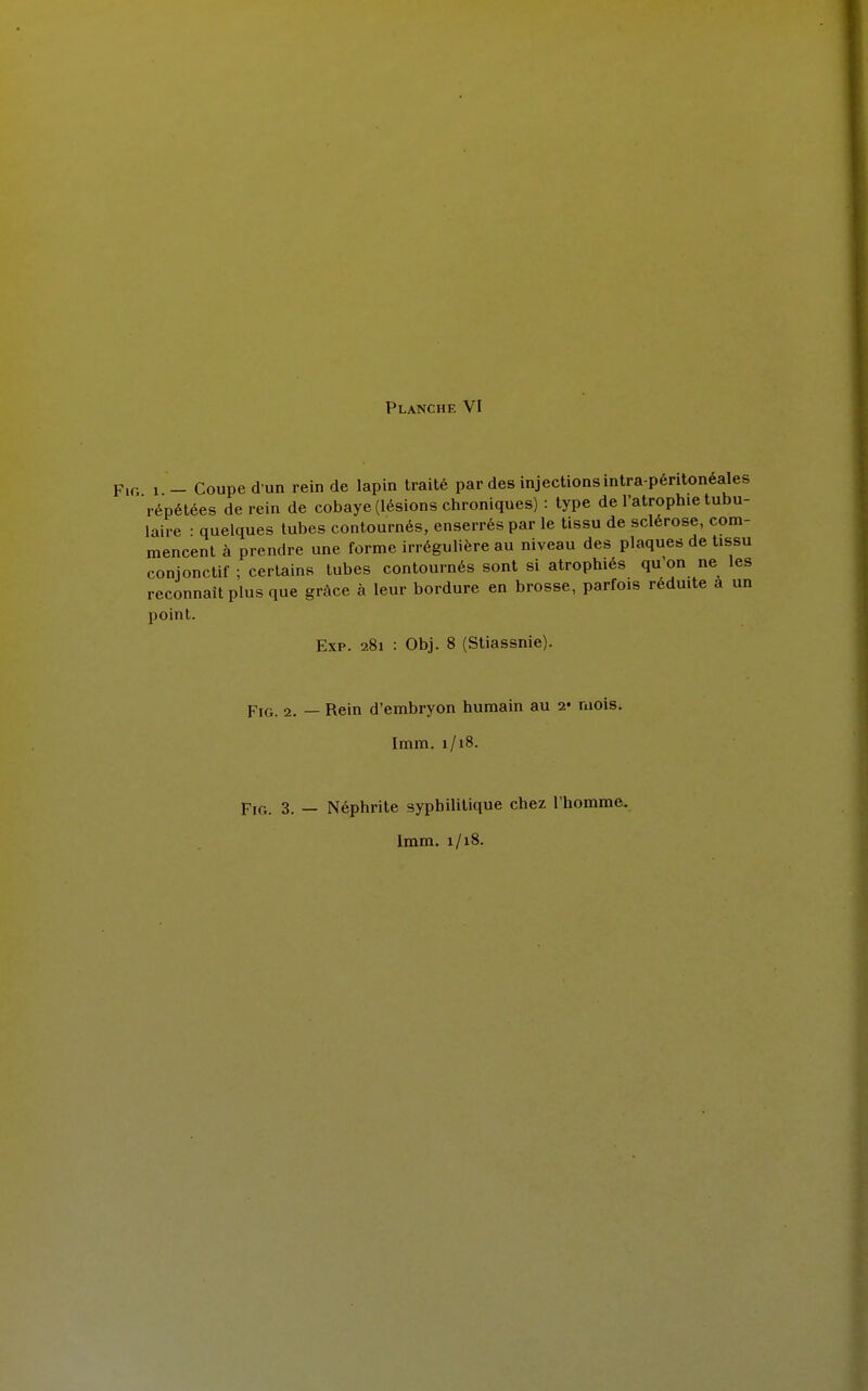 Fig 1 - Coupe d un rein de lapin traité par des injectionsintra-péritonéales répétées de rein de cobaye (lésions chroniques) : type de l'atrophie tabu- laire • quelques tubes contournés, enserrés par le tissu de sclérose, com- mencent à prendre une forme irrégulière au niveau des plaques de tissu conjonctif ; certains tubes contournés sont si atrophiés qu'on ne les reconnaît plus que grâce à leur bordure en brosse, parfois réduite a un point. Exp. 281 : Obj. 8 (Stiassnie). Fig. 2. — Rein d'embryon humain au 2- mois. Imm. 1/18. Fin. 3. — Néphrite syphilitique chez l'homme. 1mm. 1/18.