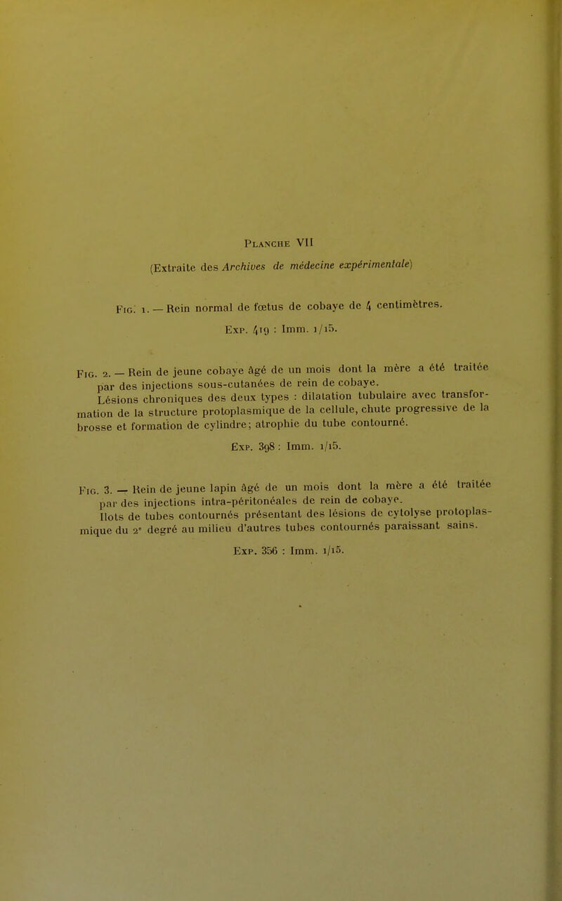 (Extraite des Archives de médecine expérimentale) Fig. i. —Rein normal de fœtus de cobaye de 4 centimètres. Exp. 419 : Imm. 1 /15. Fig. 2. — Rein de jeune cobaye âgé de un mois dont la mère a été traitée par des injections sous-cutanées de rein de cobaye. Lésions chroniques des deux types : dilatation tubulaire avec transfor- mation de la structure protoplasmique de la cellule, chute progressive de la brosse et formation de cylindre ; atrophie du tube contourné. Exp. 3g8 : Imm. i/i5. Fig. 3. — Rein de jeune lapin âgé de un mois dont la mère a été traitée par des injections intra-péritonéales de rein de cobaye. Ilots de tubes contournés présentant des lésions de cytolyse protoplas- mique du 2e degré au milieu d'autres tubes contournés paraissant sains.