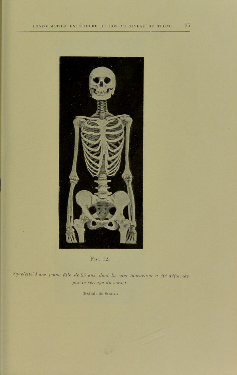 Fic. 12. Squelette d une jeune fille de 25 ans. dont la cage thoracique a été déformée par le serrage du corset.