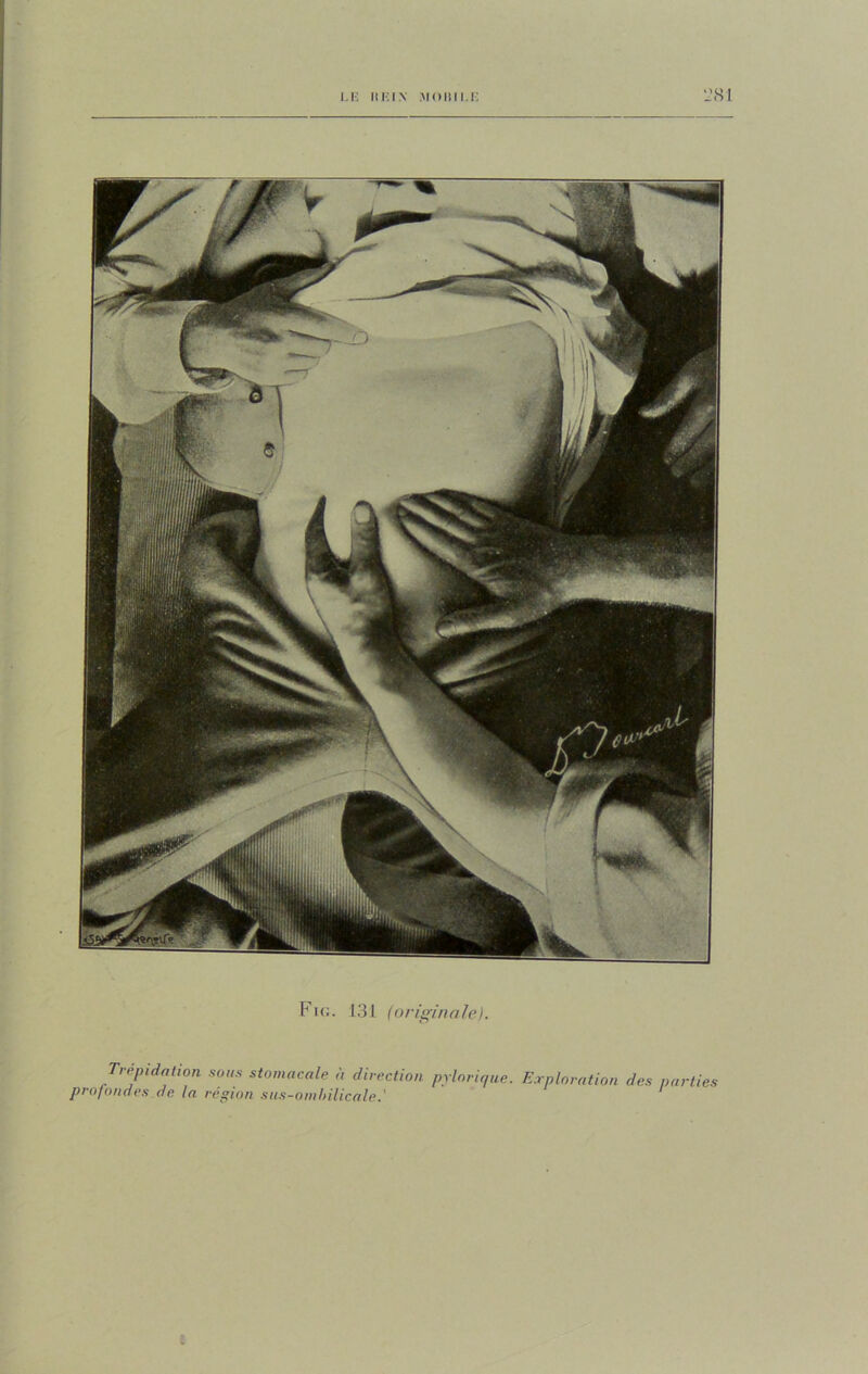 LE Hlî IX MO 11 ILE ‘J SI Fig. 131 (originale). Trépidation sons stomacale à direction pylorique. Exploration des parties profondes de la région sus-ombilicale.'