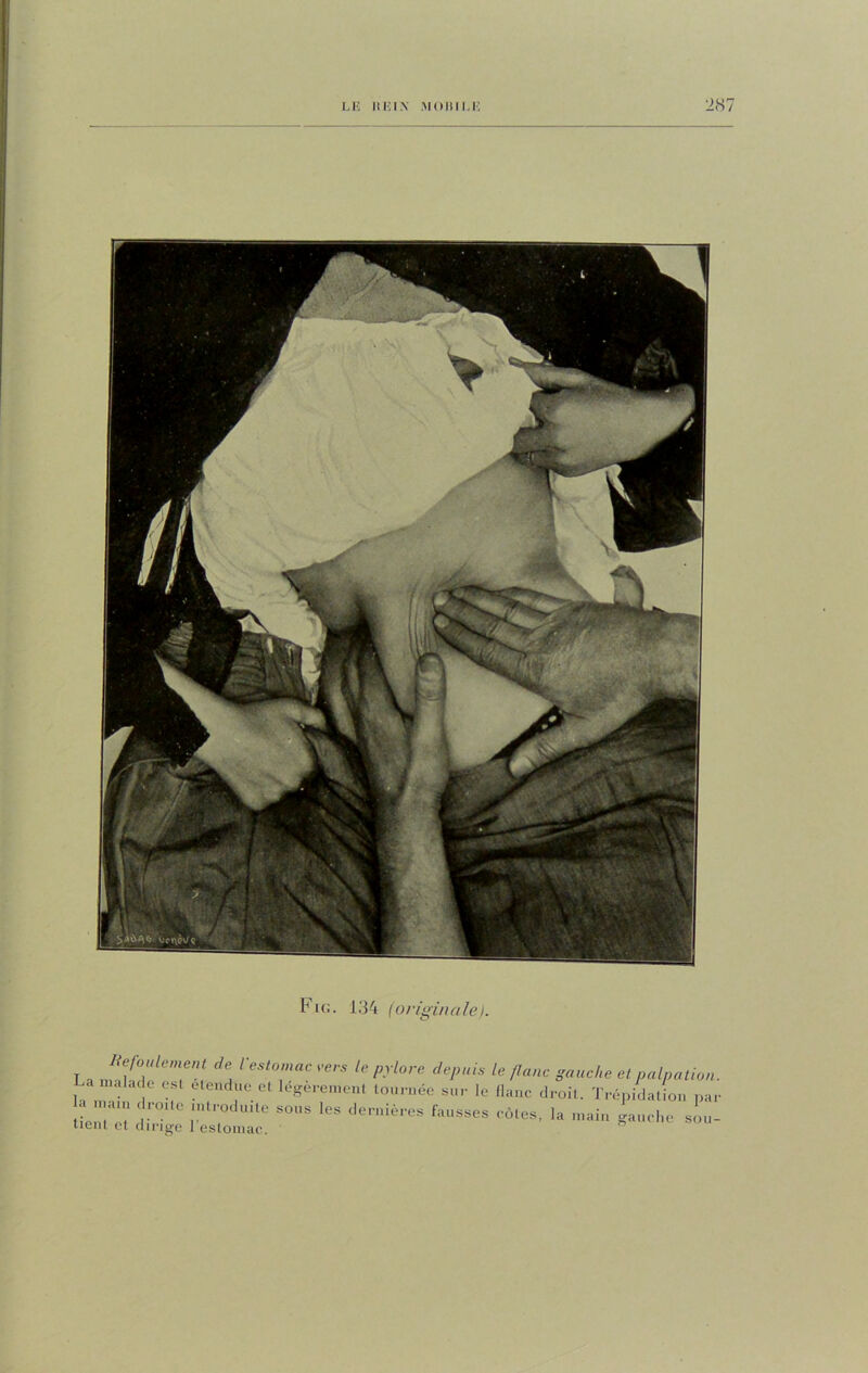 lHi<;. 134 (originale). Refoulement de l'estomac vers le pylore depuis La malade esl étendue et légèrement tournée sur le la mam droite introduite sous les dernières fausses tient et dirige l'estomac. le flanc gauche et palpation. flanc droit. Trépidation par côtes, la main gauche sou-