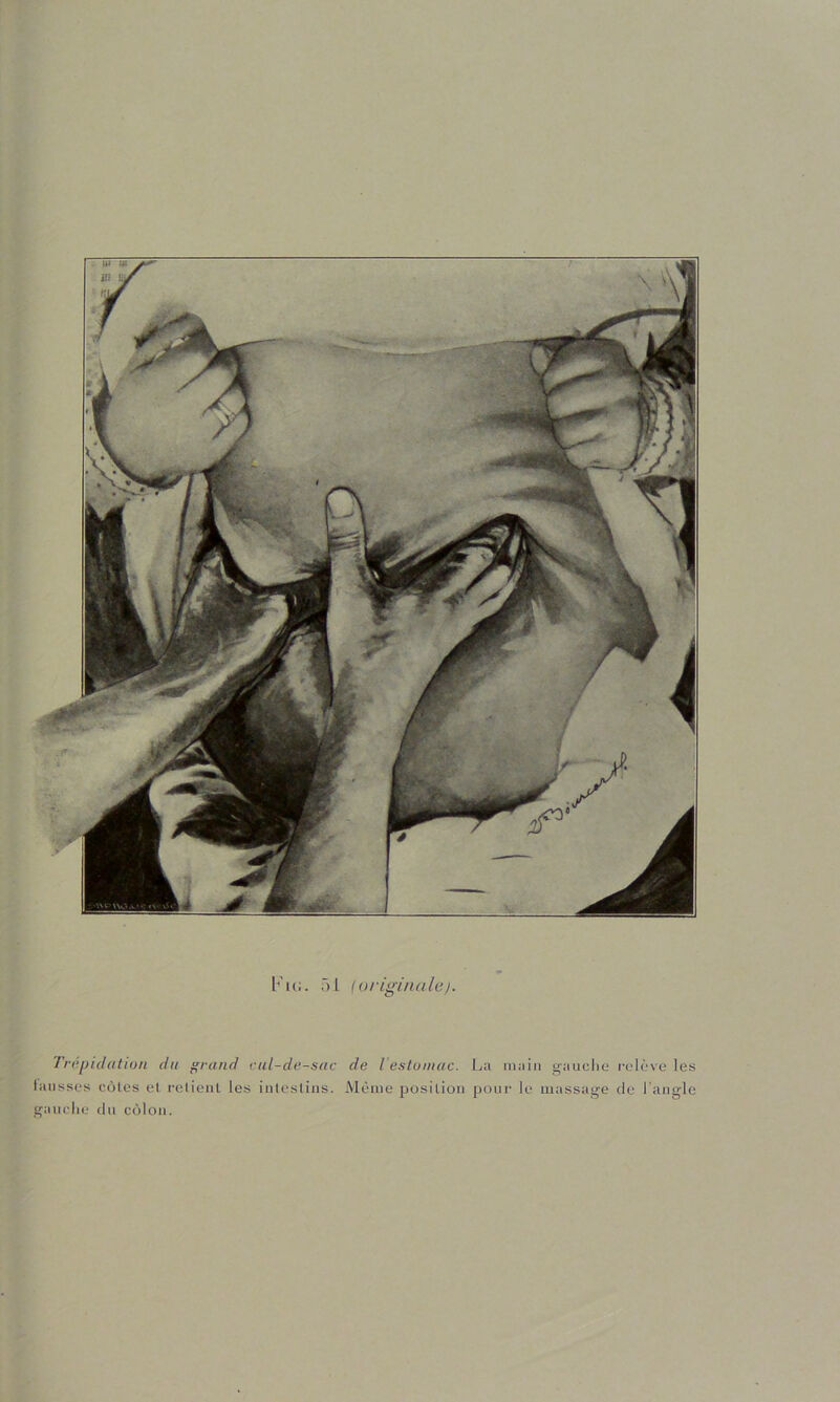 31 ioriginale). Trépidation du ^rand cul-de-sac liitiisses côtes el l'elicnt les iiileslins. gauclie du côlon. de l esluinac. La main gauclie l•elève les Même position ponc le massage de l’angle