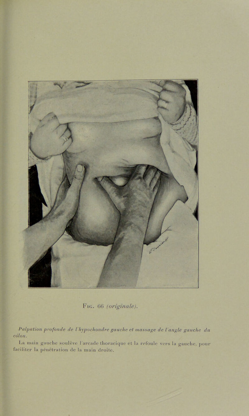 Palijatiüii profonde de l'hypochondre gauche et nias.sage de l angle gauche du colon. La main franclie soulève l'arcatle llioi'acique el la rel'oule voi-s la ganclie, jjoiii- facililcr la pénétration île la main droite.