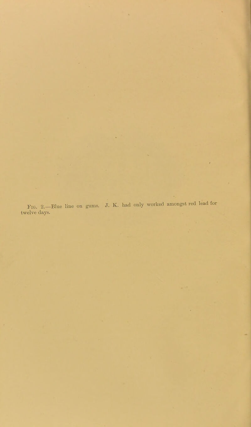 Fig. 2.-Blue line on gums. J. K. had only worked amongst red lead for twelve days.