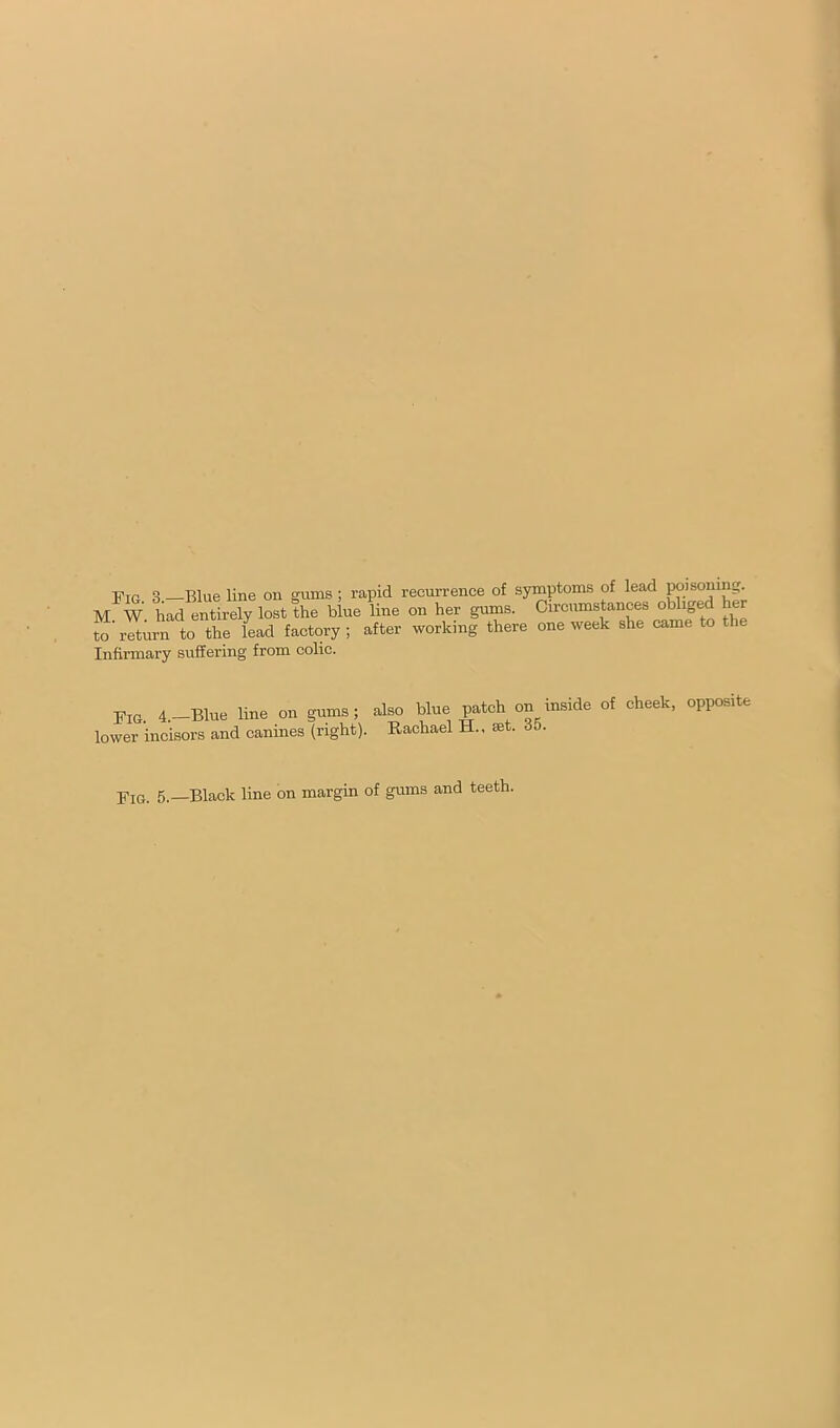 Fig 3 —Blue line on gums ; rapid recurrence of symptoms of lead ^isoning. M W Ld entirely lost the blue line on her gums. Circumstances obliged her to return to the lead factory ; after working there one week she came to the Infirmary suffering from colic. p'jQ 4,—Blue line on gums ; lower incisors and canines (right). also blue patch on inside of cheek, opposite Rachael H., set. 35. and teeth. Fig. 5.—Black line on margin of gums
