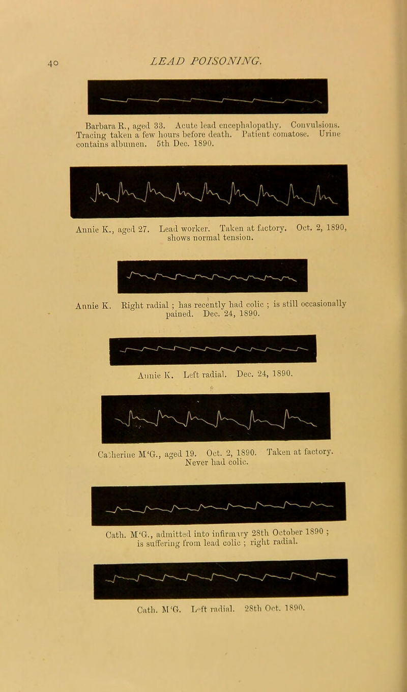 Barbara R,, aged 33. Acute lead enceplialopathy. Convulsions. Tracing taken a few hour-s before death. I’atient comatose. Urine contains albumen, fjth Dec. 1890. Annie K., aged 27. Lead worker. Taken at factory. Oct, 2, 1890, shows normal tension. Annie K. Right radial ; has recently had colic ; is still occasionally pained. Dec. 24, 1890. I Annie K. Left radial. Dec. 24, 1890. Oath. M‘G., admitted into infirmiry 28th October 1890 ; is sulfering from lead colic ; right radial. Oath. M‘0. L“ft radial. 28th Oct. 1890.