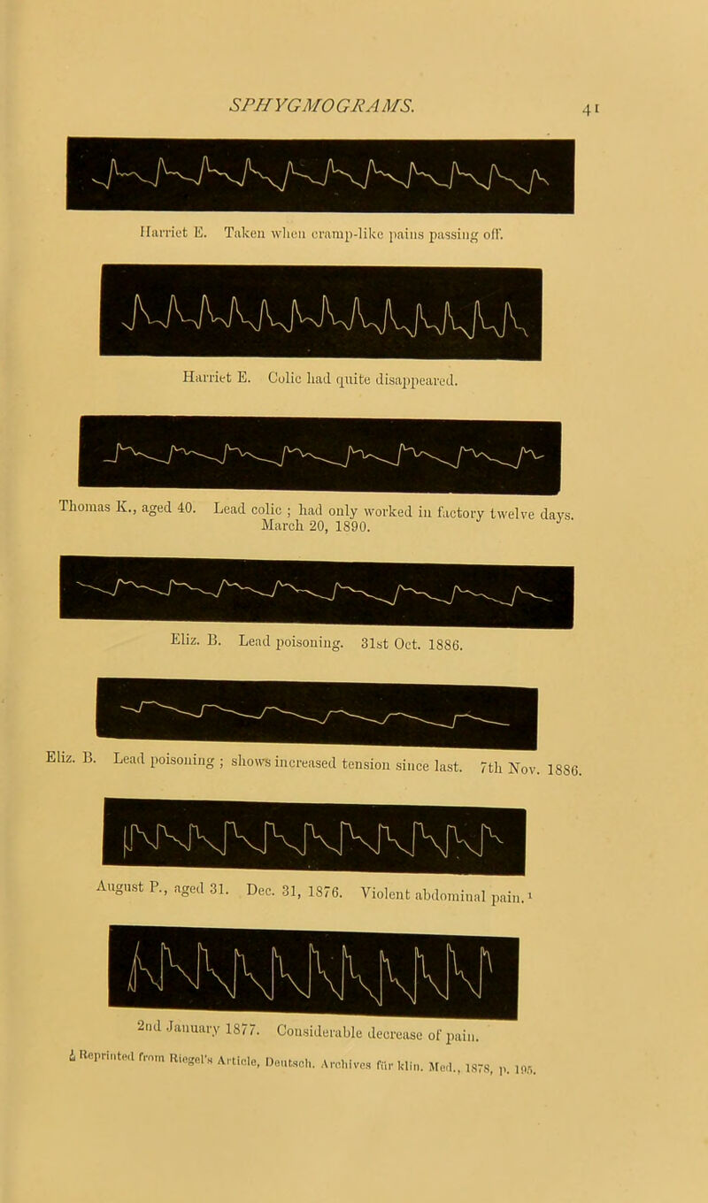 IIiiiTiet E. Tiikeii wlien cramp-like pains passing oil’. Harriet E. Colic liad quite disajipeared. Thomas K., aged 40. Lead eolic ; had only worked in factory twelve days March 20, 1890. ' Eliz. B. Lead poisoning. 31st Oct. 1886. August P., aged 31. Dec. 31, 1876. Violent abdominal pain. ^ ' h 1 \ : b M 1 ^ L 1 'v i '' 1 'v '^1 V 2nd .January 1877. Considerable decrease of pain. i Reprinted frnin Riegel’.s Artie.le, Dontscli. .\re,liive.s fiir kliii, Jted., l.STS, p. 10.').