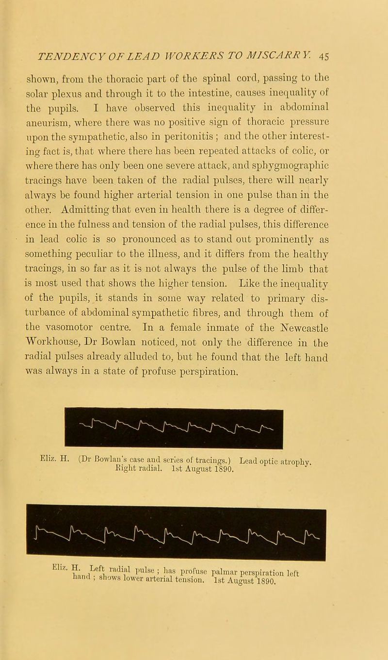 shown, from the thoracic part of the spinal cord, passing to the solar plexus and through it to the intestine, causes inequality of the pupils. I have observed this inequality in abdominal aneurism, where there was no positive sign of thoracic pressure upon the sympathetic, also in peritonitis ; and the other interest- ing fact is, tliat where there has been repeated attacks of colic, or where there lias only been one severe attack, and sphygmographic tracings have been taken of the radial pulses, there will nearly always be found higher arterial tension in one pulse than in the other. Admitting that even in health there is a degree of differ- ence in the fulness and tension of the radial pulses, this difference in lead colic is so pronounced as to stand out prominently as something peculiar to the illness, and it differs from the healthy tracings, in so far as it is not always the pulse of the limb that is most used that shows the higher tension. Like the inequality of the pupils, it stands in some way related to primary dis- turbance of abdominal sympathetic fibres, and through them of the vasomotor centre. In a female inmate of the Newcastle Workhouse, Dr Bowlan noticed, not only the difference in the radial pulses already alluded to, but lie found that the left hand was always in a state of profuse perspiration. Eliz, H. (Dr Bowlan’s case ami series of tracings.) Lead optic atrophy. Eight radial. 1st August 1890. profuse palmar persiuration left liand , shows lower arterial tension. 1st August 1890.