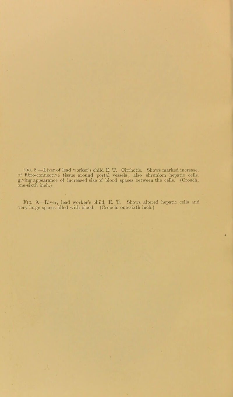 Fig. 8.—Liver of lead worker’s child E. T. Cirrhotic. Shows marked increase, of fibro-connective tissue around portal vessels; also shrunken hepatic cells, giving appearance of increased size of blood spaces between the cells. (Crouch, one-sixth inch.) Fig. 9.—Liver, lead worker’s child, E. T. Shows altered hepatic cells and very large spaces filled with blood. (Crouch, one-sixth inch.)