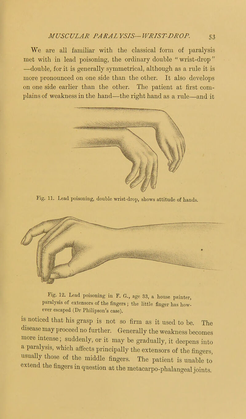 We are all familiar with the elassical form of paralysis met with in lead poisoning, the ordinary double “ wrist-drop ” —double, for it is generally symmetrical, although as a rule it is more pronounced on one side than the other. It also develops on one side earlier than the other. The patient at first com- plains of weakness in the hand—the right hand as a rule—and it Fig. 11. Lead poisoning, double wrist-drop, shows attitude of hands. Fig. 12. Lead poisoning in F. G., age 33, a house painter, paralysis of extensors of the fingers ; the little finger has how- ever escaped (Dr Philipson’s case). is noticed that his grasp is not so firm as it used to be. The disease may proceed no further. Generally the weakness becomes more intense; suddenly, or it may be gradually, it deepens into a paralysis, which affects principally the extensors of the fingers, usually those of the middle fingers. The patient is unable to extend the fingers in question at the metacarpo-phalangeal joints.