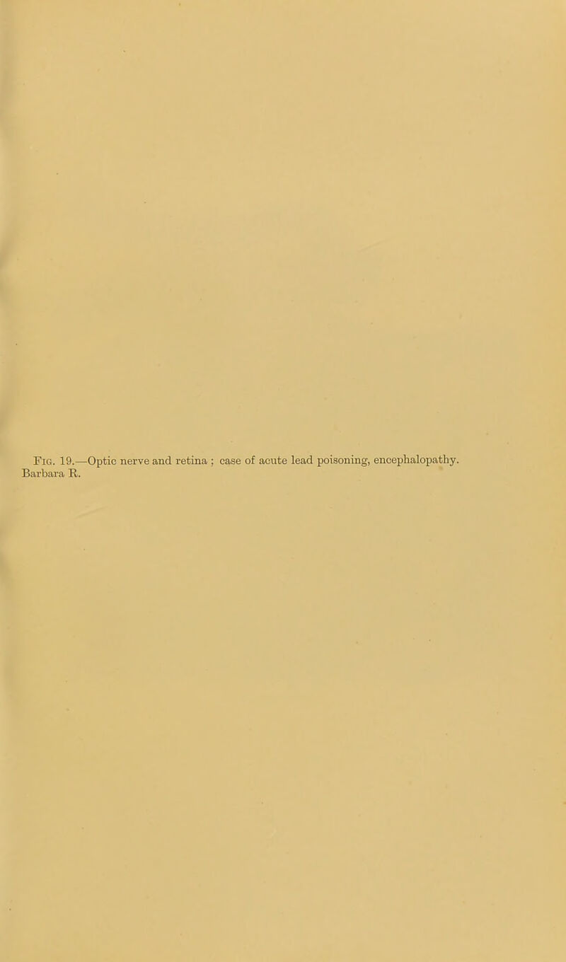 Fig. 19.—Optic nerve and retina ; case of acute lead poisoning, encephalopathy. Barbara R.
