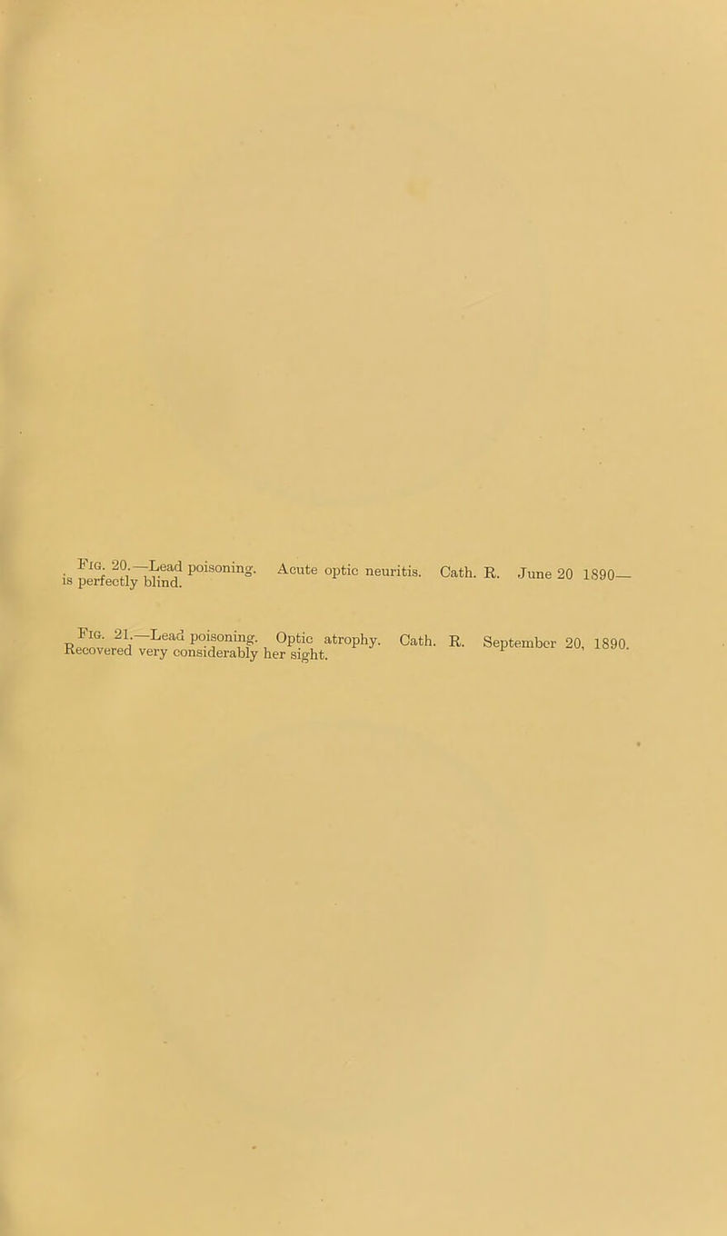 Fig. 20.—Lead poisoning, is perfectly blind. Acute optic neuritis. Oath. R. June 20 1890 Fig. 21 —Lead poisoning. Optic atrophy. Oath. R. Recovered very considerably her sight. September 20, 1890.