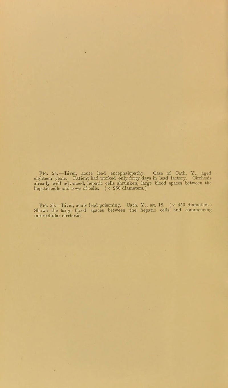 Fig. 24.—Liver, acute lead encephalopathy. Case of Gath. Y., aged eighteen years. Patient had worked only forty days in lead factory. Cirrhosis already well advanced, hepatic cells shrunken, large blood spaces between the hepatic cells and rows of cells. ( x 250 diameters.) Fig. 25.—Liver, acute lead poisoning. Cath. Y., ast. 18. ( x 450 diameters.) Shows the large blood spaces between the hepatic cells and commencing intercellular cirrhosis.