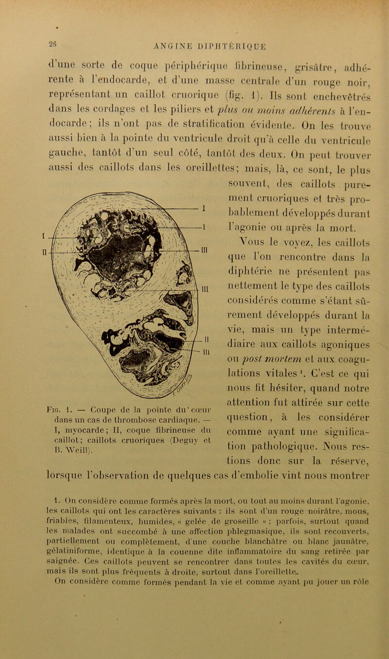 ANGINE l)Ii»IITlUUQUE <rune sorte de coque péripliéri(|iie libidneuse, ^q-isâtre, adlié- rente à l’enclocarcle, et d’une masse centrale d’un rouge noir, représentant un caillot cruorique (fig. 1). Ils sont enchevêtrés dans les cordages et les piliers et plus ou moins adhérenls à l’en- docarde ; ils n’ont pas de straliliCation évidente. On les trouve aussi bien à la pointe du ventricule droit qu’à celle du ventricule gauche, tantôt d’un seul côté, tantôt des deux. On peut trouvei* aussi des caillots dans les oreillettes; mais, là, ce sont, le plus souvent, des caillots pure- ment cruoriques et très pro- hahlement développés durant l’agonie ou après la mort. Vous le voyez, les caillots que l’on rencontre dans la diphtérie ne présentent pas nettement le type des caillots considéi'és comme s’étant sû- rement développés durant la vie, mais un type intermé- diaire aux caillots agoniques ou post mortern et aux coagu- lations vitales *. C’est ce qui nous lit hésiter, quand notre attention fut attirée sur cette question, à les considérer comme ayant une significa- tion pathologique. INous res- tions donc sur la réserve, lorsque l’observation de quelques cas d’embolie vint nous montrer 1. On considère comme formés après la mort, ou tout au moins durant l’agonie, les caillots qui ont les caractères suivants : ils sont d'un rouge noirâtre, mous, friables, filamenteux, liumides, « gelée de groseille »; parfois, surtout quand les malades ont succombé à une alTection phlcgmasique, ils sont recouverts, partiellement ou complètement, d une couche blanchâtre ou blanc jaunâtre, gélatiniforme, identique à la couenne dite inflammatoire du sang retirée par saignée. Ces caillots peuvent se rencontrer dans toutes les cavités du cœur, mais ils sont plus fréiiucnts à droite, surtout dans l’oreillette,. On considère comme formés pendant la vie et comme ayant pu jouer un rôle Fig. 1. — Coupe de la pointe du'cœur dans un cas de thrombose cardiaque. — l, myocarde ; II, coque fibrineuse du caillot: caillots cruoriques (Deguv et Tl. Weill).
