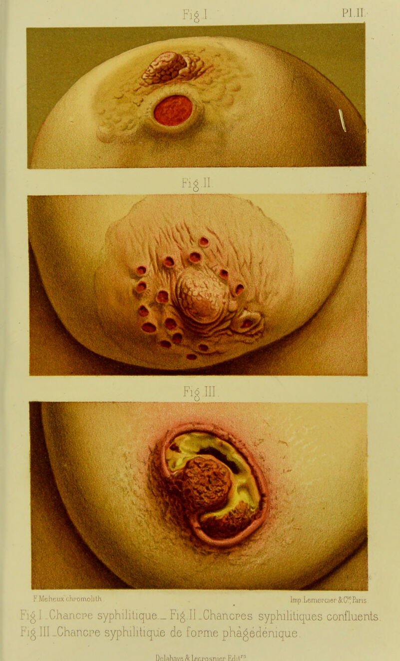 Fig m FMehcuxohromolilh Imp l,Bnu;rcier&C'Paris F]g l-Ghancpe syphilitique _ Fig.Il _Chancpes syphilitiques confluents FiglILChancpe syphilitique de forme phàgédénique. Dfîiflhnuc Â l.ftr.pnsTiir.r F.rlil''^