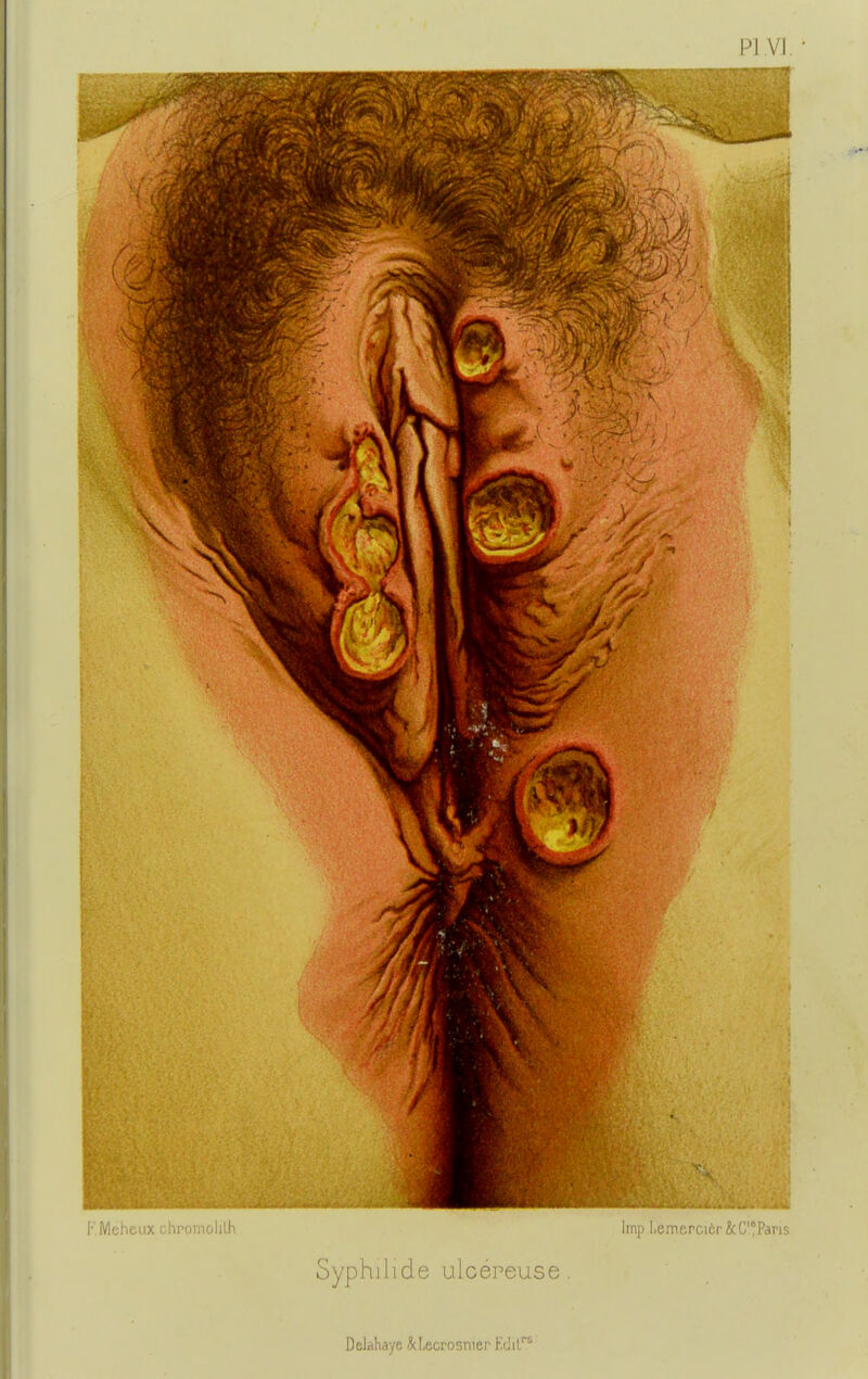 [•' Meheux chromolilh Syphilide ulcéreuse