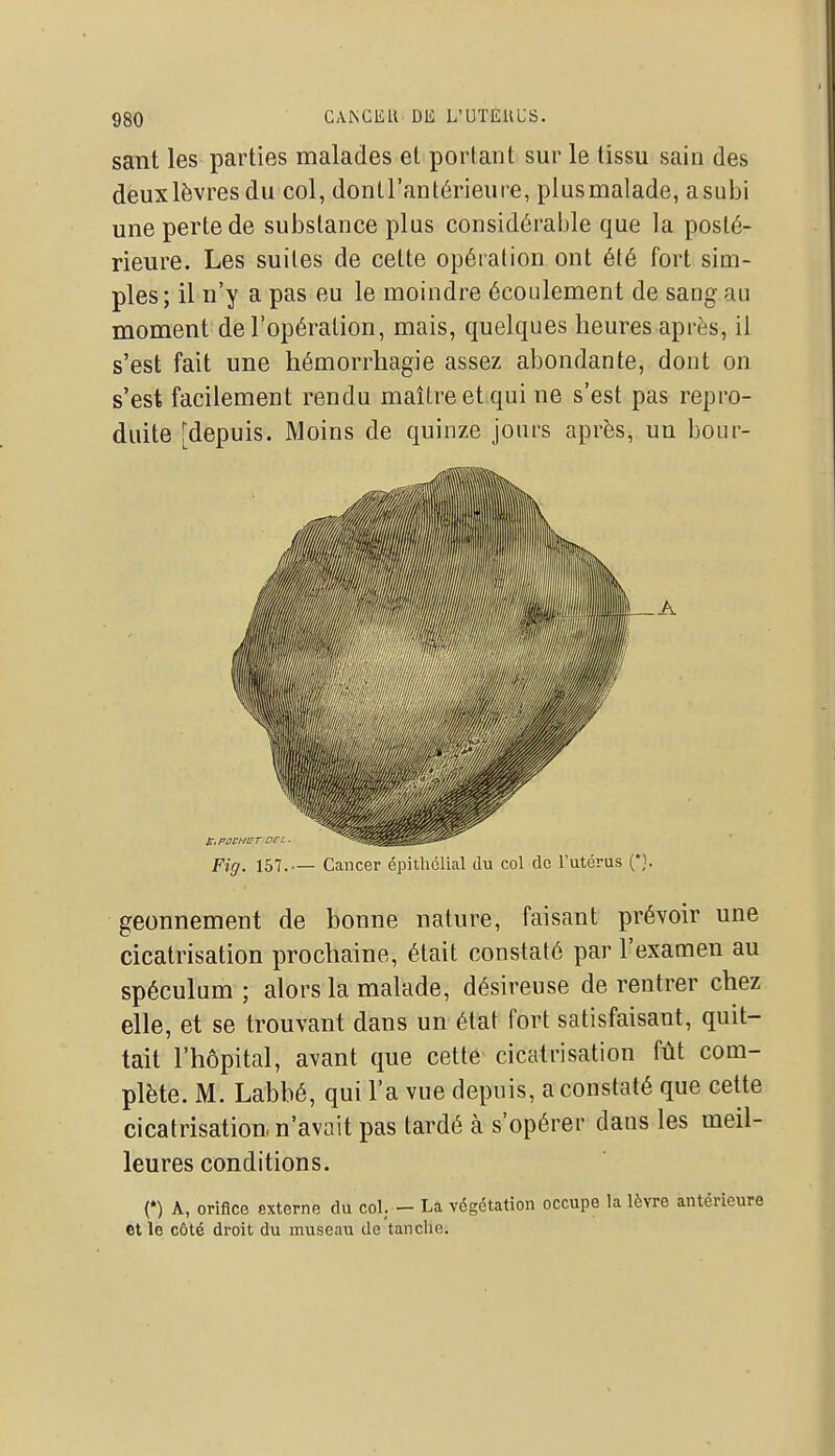 sant les parties malades et portant sur le tissu sain des deuxlèvresdu col, dontl'antérieure, plusmalade, a subi une perte de substance plus considérable que la posté- rieure. Les suites de cette opération ont été fort sim- ples; il n'y a pas eu le moindre écoulement de sang au moment de l'opération, mais, quelques heures après, il s'est fait une hémorrhagie assez abondante, dont on s'est facilement rendu maître et qui ne s'est pas repro- duite [depuis. Moins de quinze jours après, un bour- Fig. 157.— Cancer épitholial du col de Tutérus (*} geonnement de bonne nature, faisant prévoir une cicatrisation prochaine, était constaté par l'examen au spéculum; alors la malade, désireuse de rentrer chez elle, et se trouvant dans un état fort satisfaisant, quit- tait l'hôpital, avant que cette cicatrisation fût com- plète. M. Labbé, qui l'a vue depuis, a constaté que celte cicatrisation, n'avait pas tardé à s'opérer dans les meil- leures conditions. (*) A, orifice externe du col. — La végétation occupe la lèvre antérieure et le côté droit du museau de tanclie.