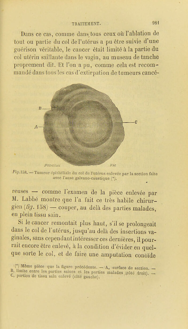 Dans ce cas, comme dans tous ceux où l'ablation de tout ou partie du col de l'utérus a pu être suivie d'une guérison véritable, le cancer était limité à la partie du col utérin saillante dans le vagin, au museau de tanche proprement dit. Et l'on a pu, comme cela est recom- mandé dans tous les cas d'extirpation de tumeurs cancé- c FigA58, — Tumeur épithéliale du col de Futérus enlevée par la section faits avec l'anse galvano-caustique (). m reuses — comme l'examen de la pièce enlevée par M. Labbé montre que l'a fait ce très habile chirur- gien [fig. 158) — couper, au delà des parties malades, en plein tissu sain. Si le cancer remontait plus haut, s'il se prolongeait dans le col de l'utérus, jusqu'au delà des insertions va- ginales, sans cependant intéresser ces dernières, il pour- rait encore être enlevé, à la condition d'évider en quel- que sorte le col, et de faire une amputation conoïde (*) Môme pièce que la figure précédente. - A, surface de section. — B, limite entre les parties saines et les parties malades (côté droit). — tj, portion de tissu sain enlevé (côté gauche).