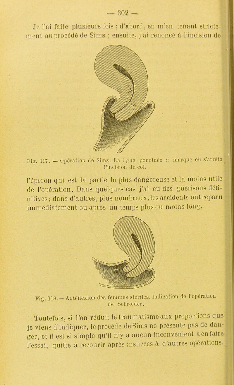Je l'ai faite plusieurs fois ; d'ftborcl, en m'en tenant stricte- ment au procédé de Sims ; ensuite, j'ai renoncé à l'incision de Fig. 117. — Opération de Sims. La ligne ponctuée a marque oii s'arrête l'incision du col. l'éperon qui est la partie la plus dangereuse et la moins utile de l'opération. Dans quelques cas j'ai eu des guérisons défi- nitives; dans d'autres, plus nombreux, les accidents ont reparu immédiatement ou après un temps plus ou moins long. Fig. lis.—Antéflexion des lenimes stériles. Indication de l'opération de Sclirœder. Toutefois, si l'on réduit le timimatismeaux proportions que je viens d'indiquer, le procédé de Sims ne présente pas de dan- ger, et il est si simple qu'il n'y a aucun inconvénient àen faire l'essai, quitte à recourir après insuccès à d'autres opérations.
