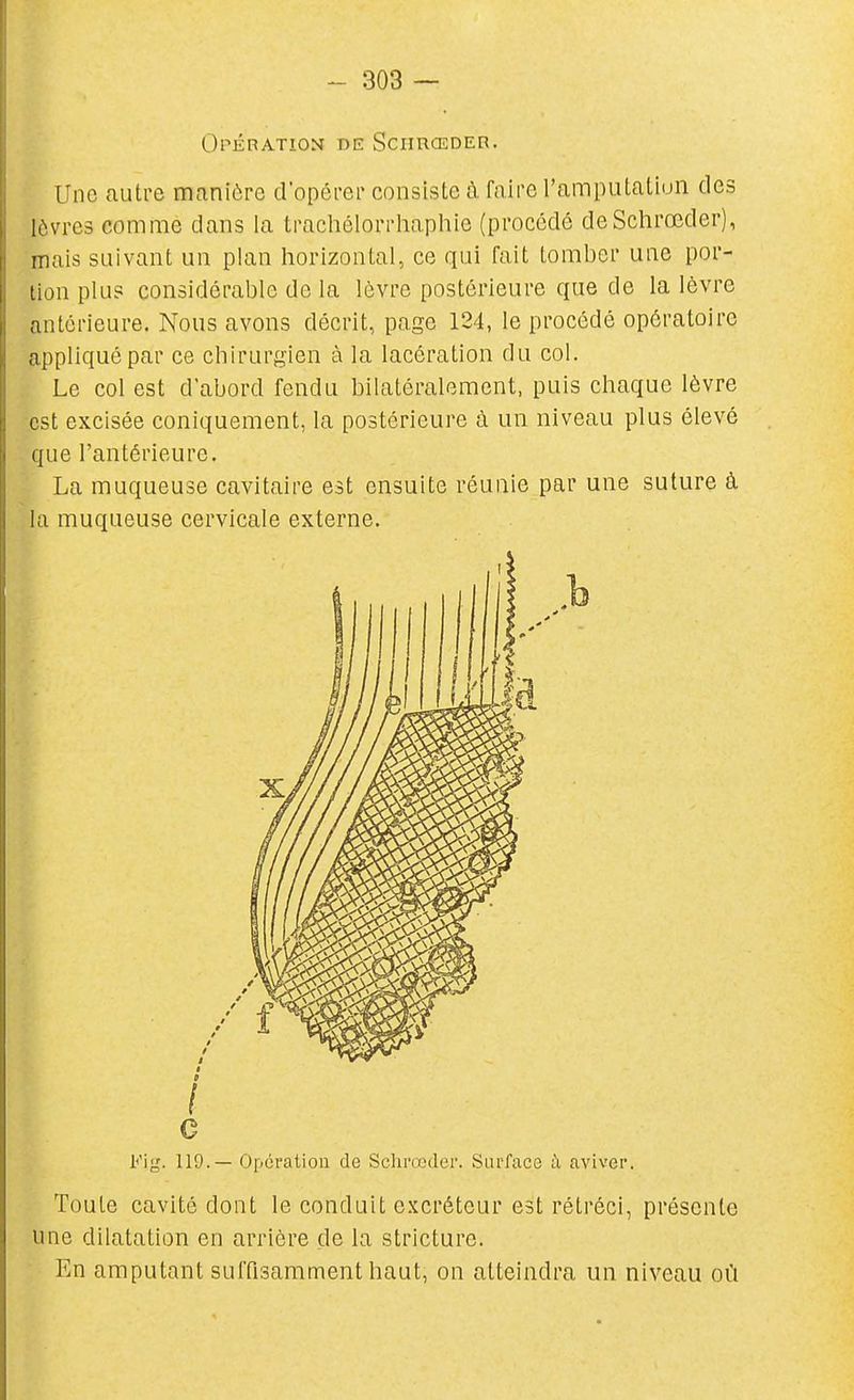 Opération de SciiuŒOEn. Une autre manière d'opérer consiste à faire rampulatiun des lèvres comme dans la trachélorrhaphie (procédé deSchrœder), mais suivant un plan horizontal, ce qui fait tomber une por- tion plu? considérable de la lèvre postérieure que de la lèvre antérieure. Nous avons décrit, page 124, le procédé opératoire appliqué par ce chirurgien à la lacération du col. Le col est d'abord fendu bilatéralement, puis chaque lèvre est excisée coniquement, la postérieure à un niveau plus élevé que l'antérieure. La muqueuse cavitaire est ensuite réunie par une suture à la muqueuse cervicale externe. / c Fig. 119.— Opération de Sclirœder. Surface à aviver. Toute cavité dont le conduit excréteur est rétréci, présente une dilatation en arrière de la stricture. En amputant suffisamment haut, on atteindra un niveau où