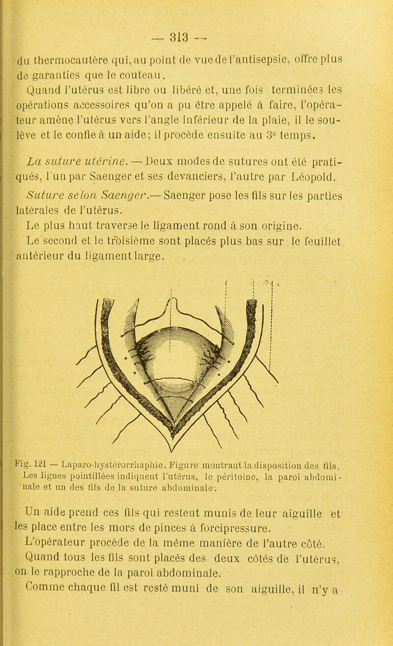 du thermocautère qui,au point de vuedel'antisepsie, offre plus de garanties que le couteau. Quand l'utérus est libre ou libéré et, une fois terminées les opérations accessoires qu'on a pu être appelé à faire, l'opéra- teur amène l'utérus vers l'angle inférieur de la plaie, il le sou- lève et le confie à un aide; il procède ensuite au 3 temps. La sutuve utérine. — Deux modes de sutures ont été prati- qués, l unpar Saenger et ses devanciers, l'autre par Léopold. Suture selon Saenger.— Saenger pose les fils sur les parties latérales de l'utérus. Le plus haut traverse le ligament rond à son origine. Le second et le troisième sont placés plus bas sur le feuillet antérieur du ligament large. Fig. 121 — Lapai'o-liystéi'orrliaphie. Figure montraut la disposition des fils. Les lignes pointillées indiquent l'utérus, le péritoine, la paroi abdomi- nale et un des fils de la suture abdominale'. Un aide prend ces fils qui restent munis de leur aiguille et les place entre les mors de pinces à forci pressure. L'opérateur procède de la même manière de l'autre côté. Quand tous les fils sont placés des deux côtés dé l'utérus, on le rapproche de la paroi abdominale. Comme chaque fil est resté muni de son aiguille, il n'y a