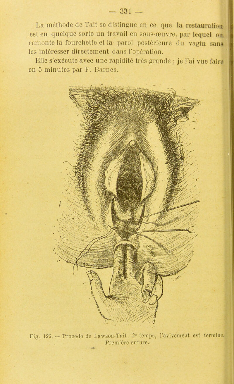 — 331 — La méthode de Tait se dislinsuc on ce que la restauration est en quelque sorte un travail en sous-œuvre, par lequel on remonte la fourchette et la- paroi postérieure du vagin sans les intéresser directement dai)s l'opération. Elle s'exécute avec une rapidité très grande ; je l'ai vue faire en 5 minutes par F. Barnes. Fig. 125. ~ Procédé ilc Lawson-Tait. 2° temps, l'avivcmeat est tcrniiuo. Première suture.