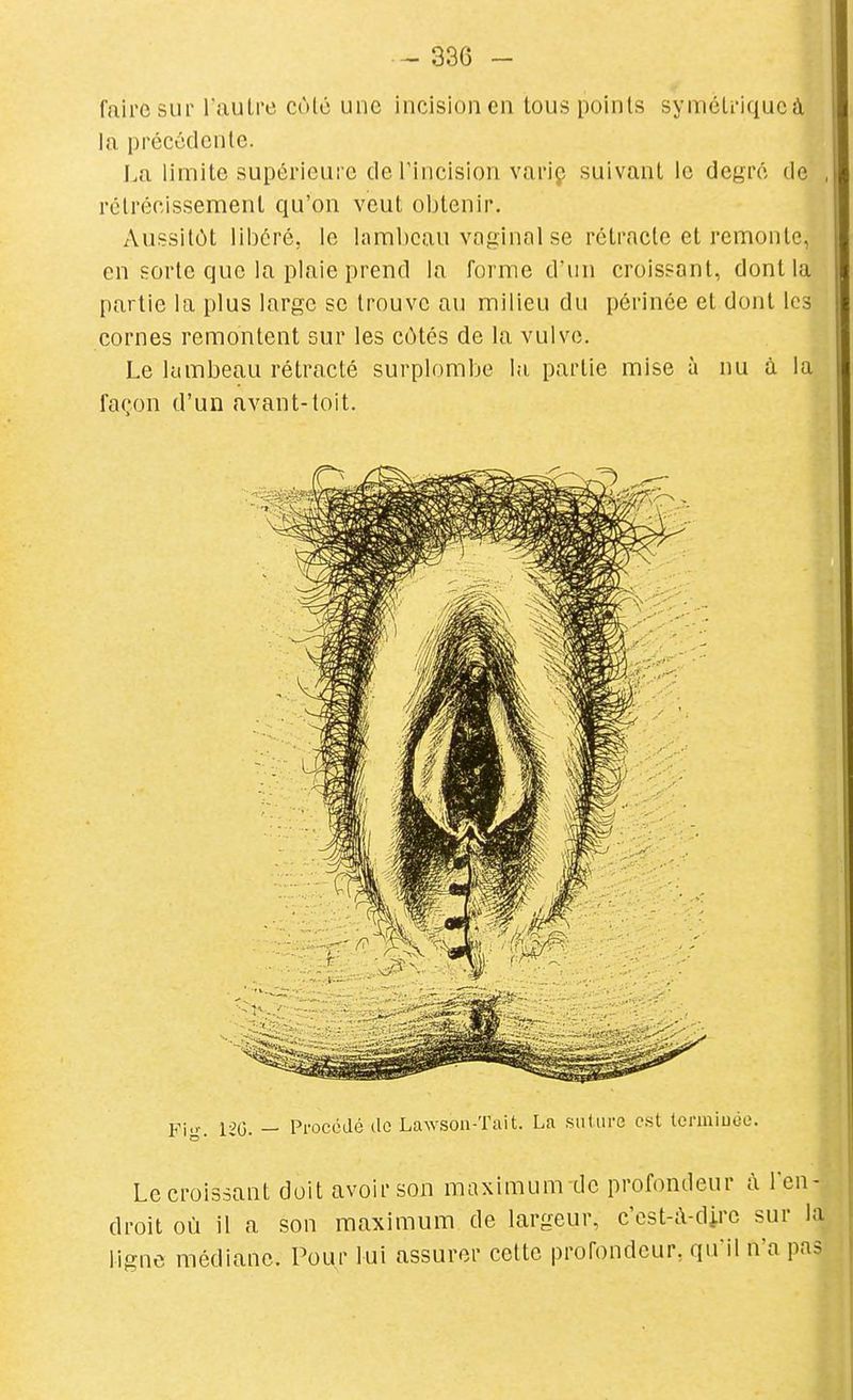 faire sur l'autre cùlc une incision en tous points symètriqucà la précédente. La limite supérieure derincision variç suivant le degré de rétrécissement qu'on veut obtenir. Aussitôt libéré, le lambeau vaginal se rétracte et remonte, en sorte que la plaie prend la forme d'un croissant, dont la partie la plus large se trouve au milieu du périnée et dont les cornes remontent sur les côtés de la vulve. Le lambeau rétracté surplombe la partie mise à nu à la façon d'un avant-toit. Fig. 120. - Procédé do Lawson-Tait. La suture est Icrmiuée. Le croissant doit avoir son maximum de profondeur à lea- droit où il a son maximum de largeur, c'est-à-dire sur la ligne médiane. Pour lui assurer cette profondeur, qu'il n'a pas