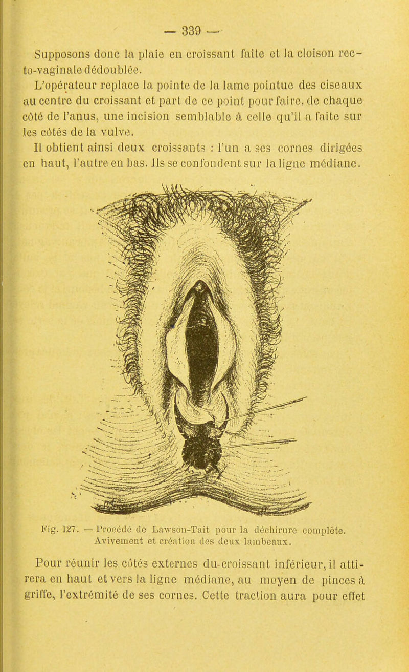 Supposons donc la piaic en croissant faite et la cloison rec- to-vaginale dédoLiblce. L'opérateur replace la pointe de la lame pointue des ciseaux au centre du croissant et part de ce point pour faire, de chaciue côté de l'anus, une incision semblable à celle qu'il a faite sur les côtes de la vulve. Il obtient ainsi deux croissants : l'un a ses cornes dirigées en haut, l'autre en bas. ils se confondent sur laligne médiane. Fig. 127. — Procédé de Lawson-Tait pour la déchirure complète. Avivement et création des deux lambeaux. Pour réunir les côtés externes du-croissant inférieur, il atti- rera en haut et vers la ligne médiane, au moyen de pinces à griffe, l'extrémité de ses cornes. Cette traction aura pour efïet