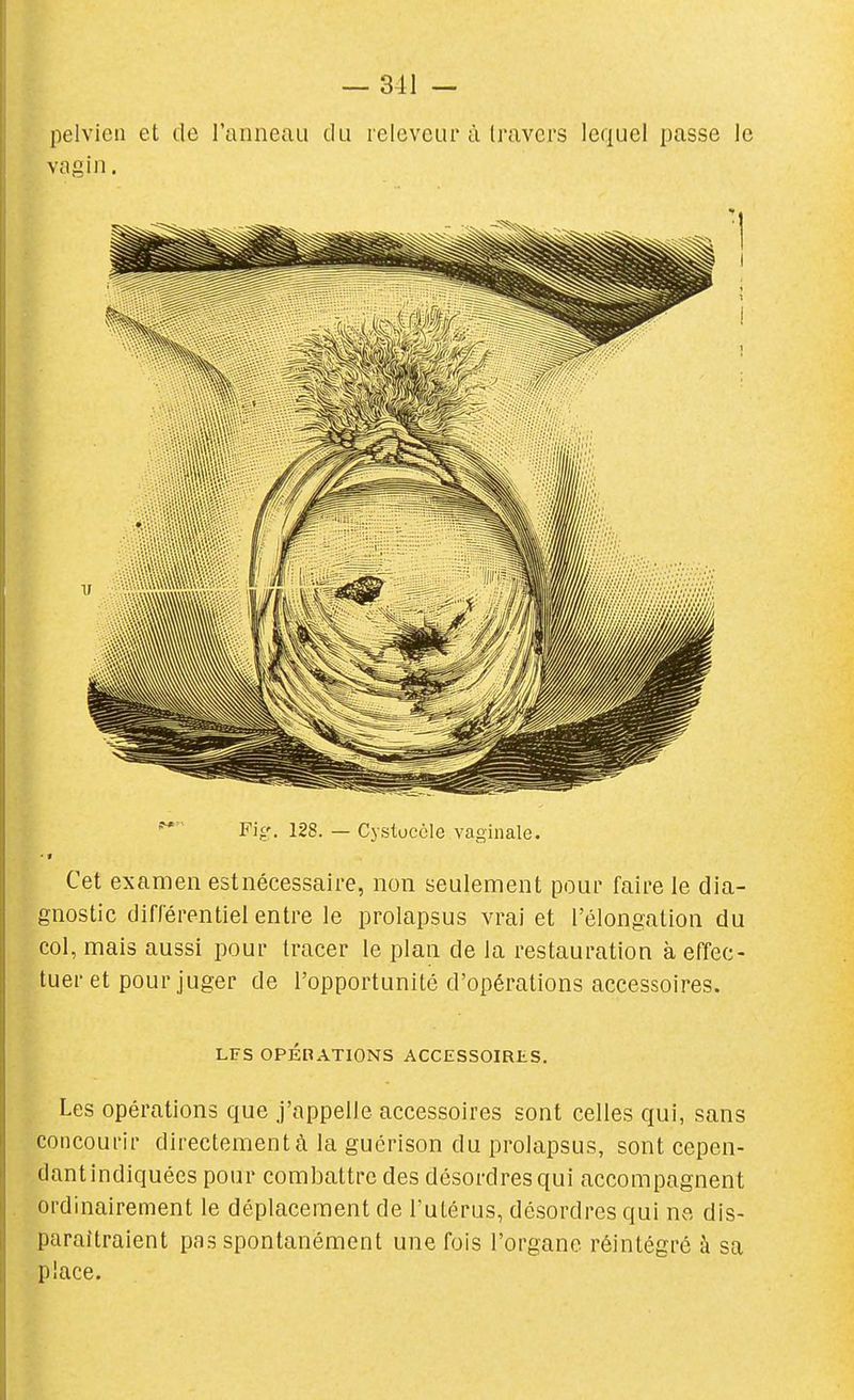 Fig. 128. — Cystoccle vaginale. Cet examen estnécessaire, non seulement pour faire le dia- gnostic différentiel entre le prolapsus vrai et l'élongalion du col, mais aussi pour tracer le plan de la restauration à effec- tuer et pour juger de l'opportunité d'opérations accessoires. LFS OPÉRATIONS ACCESSOIRIiS. Les opérations que j'appelle accessoires sont celles qui, sans concourir directement à la guérison du prolapsus, sont cepen- dantindiquées pour combattre des désordres qui accompagnent ordinairement le déplacement de l'utérus, désordres qui ne dis- paraîtraient pas spontanément une fois l'organe réintégré à sa place.